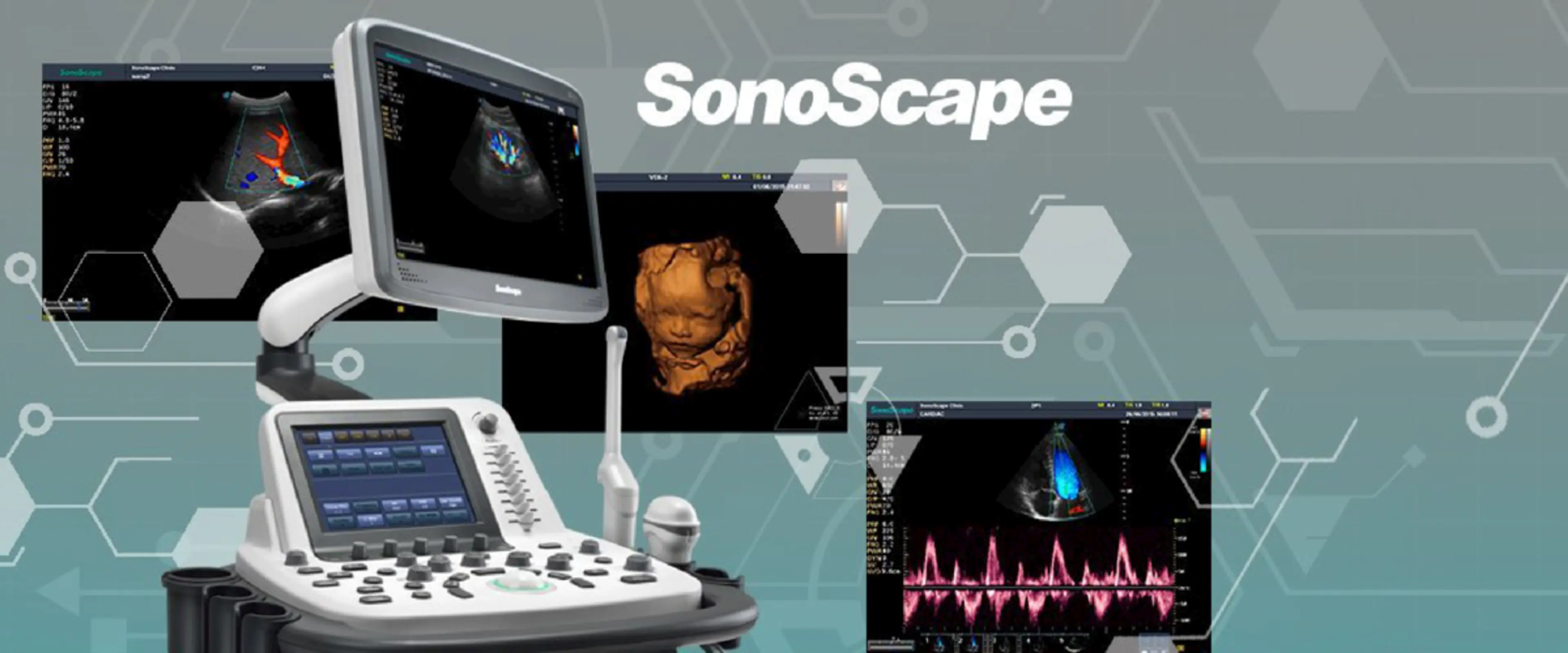 Ultralyd fra Sonoscape