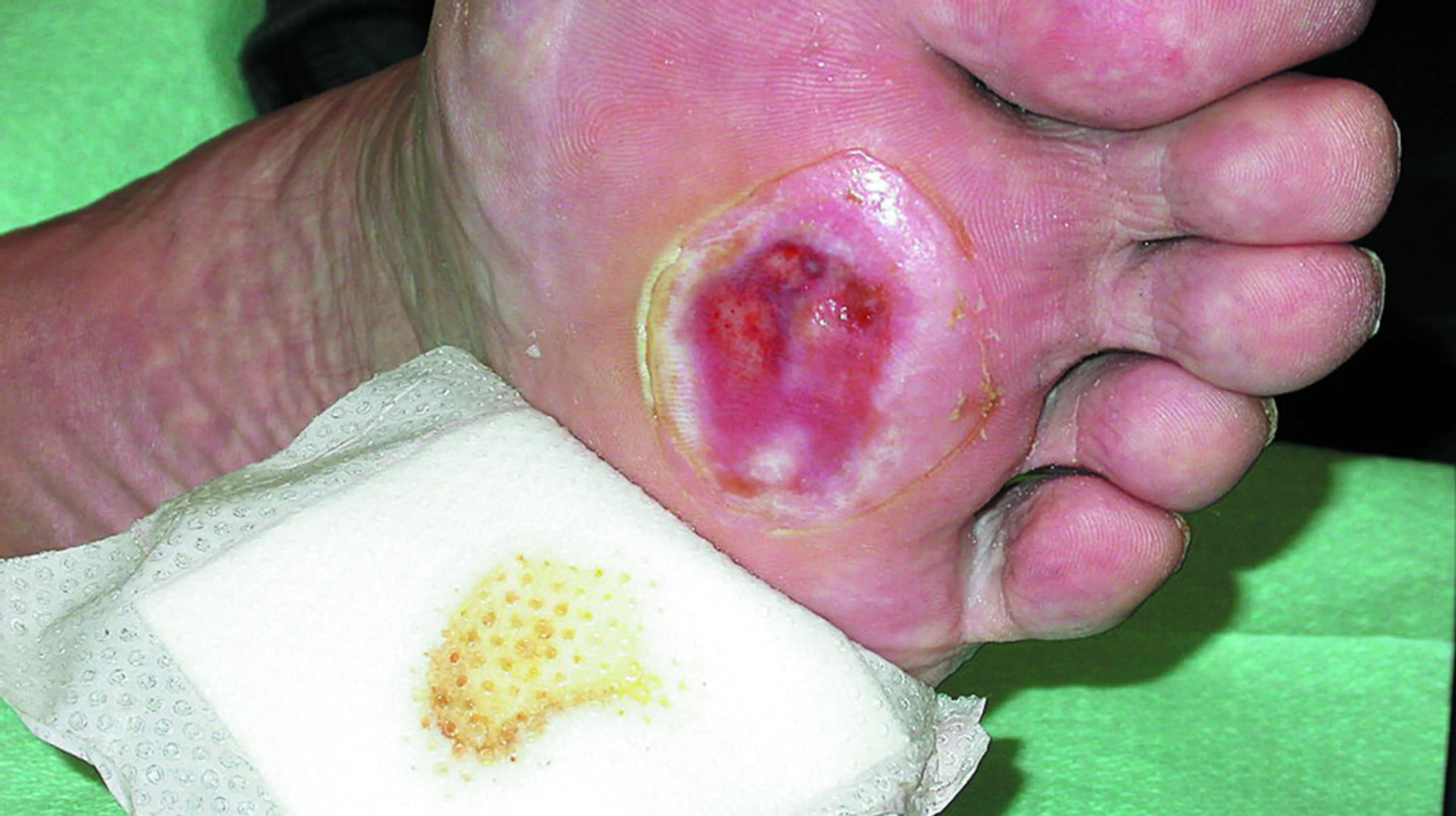 Håndtering av diabetiske fotsår starter med å vurdere, gradere og klassifisere såret basert på en klinisk evaluering av sårets omfang og dybde samt eventuelle infeksjoner, og dette avgjør typen og graden av behandlingen (2, 3). Foto: Mölnlycke