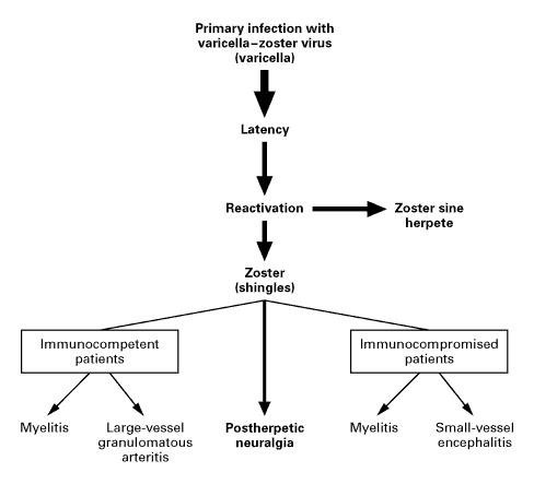 Neurologic Complications of the Reactivation of Varicella–Zoster Virus.