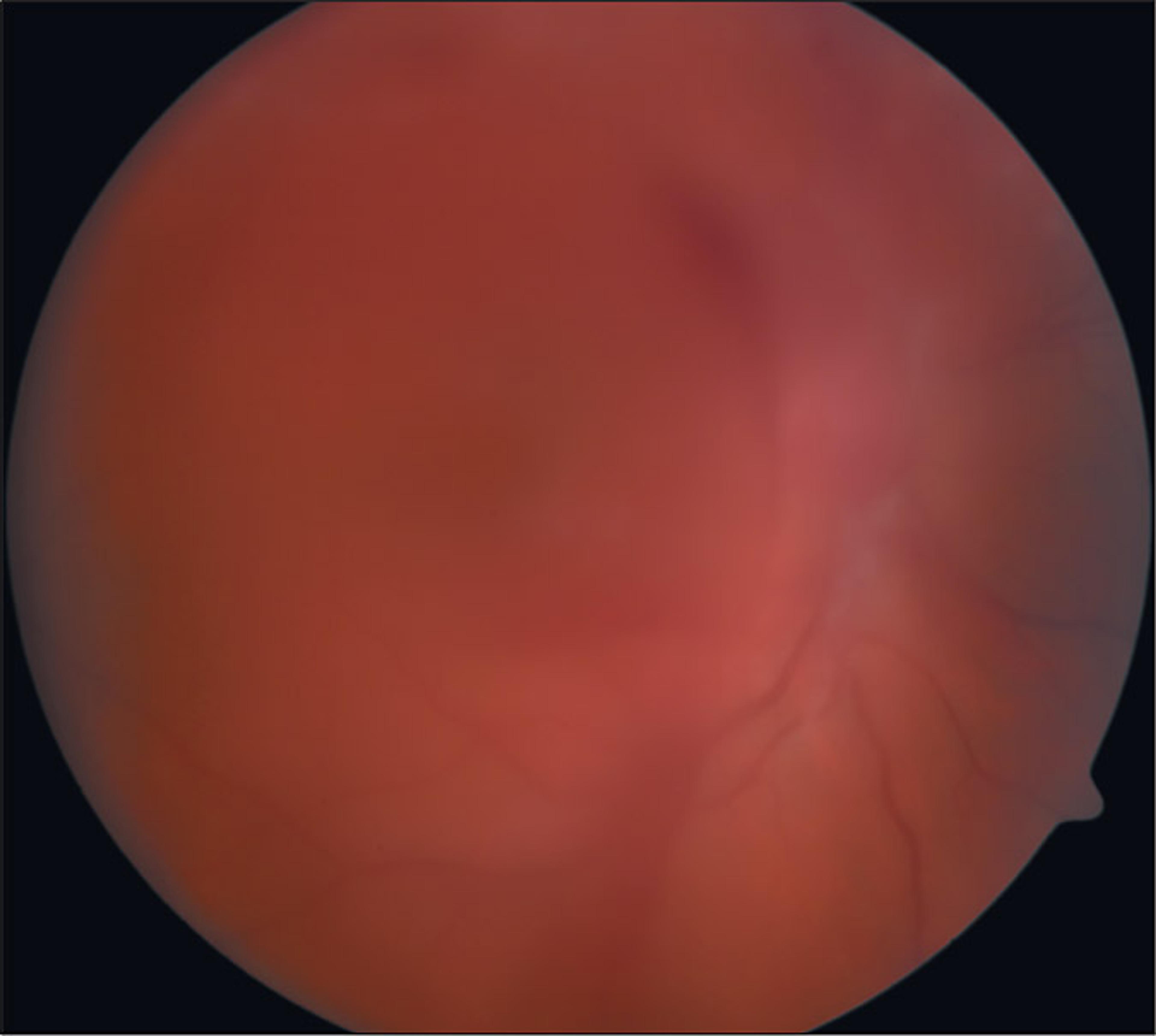 Figure 3. Fundus Photograph of Vitreous Hemorrhage