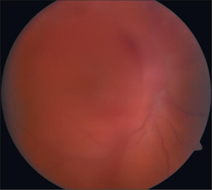 Figure 3. Fundus Photograph of Vitreous Hemorrhage