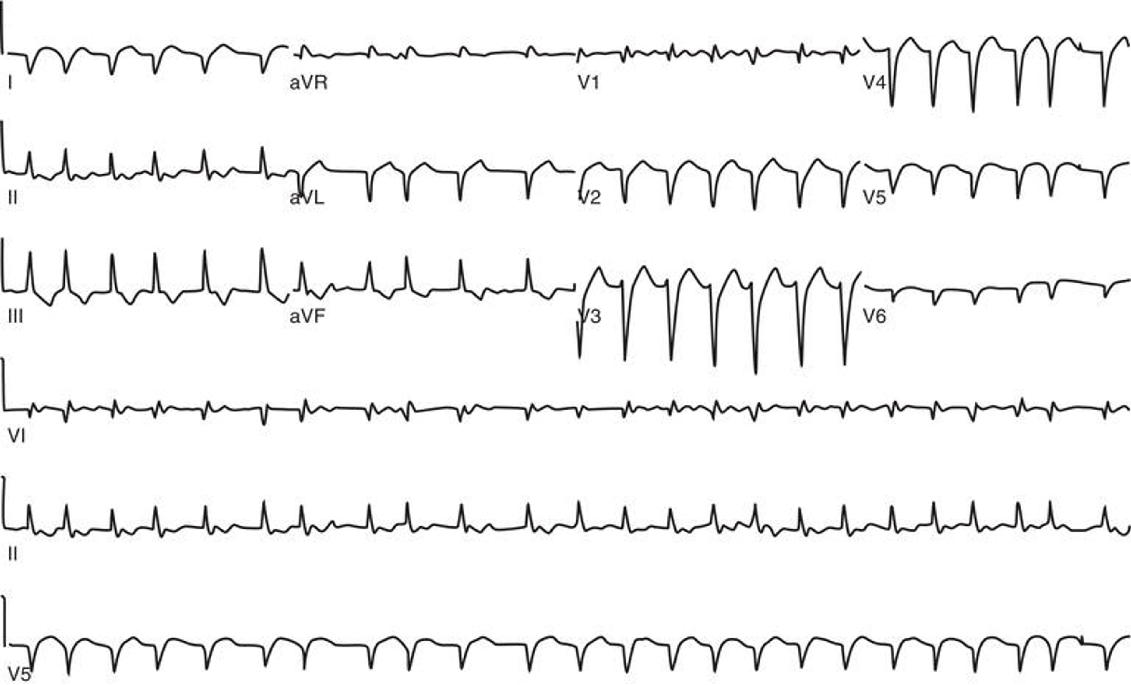 Atrial fibrillation with rapid ventricular response.