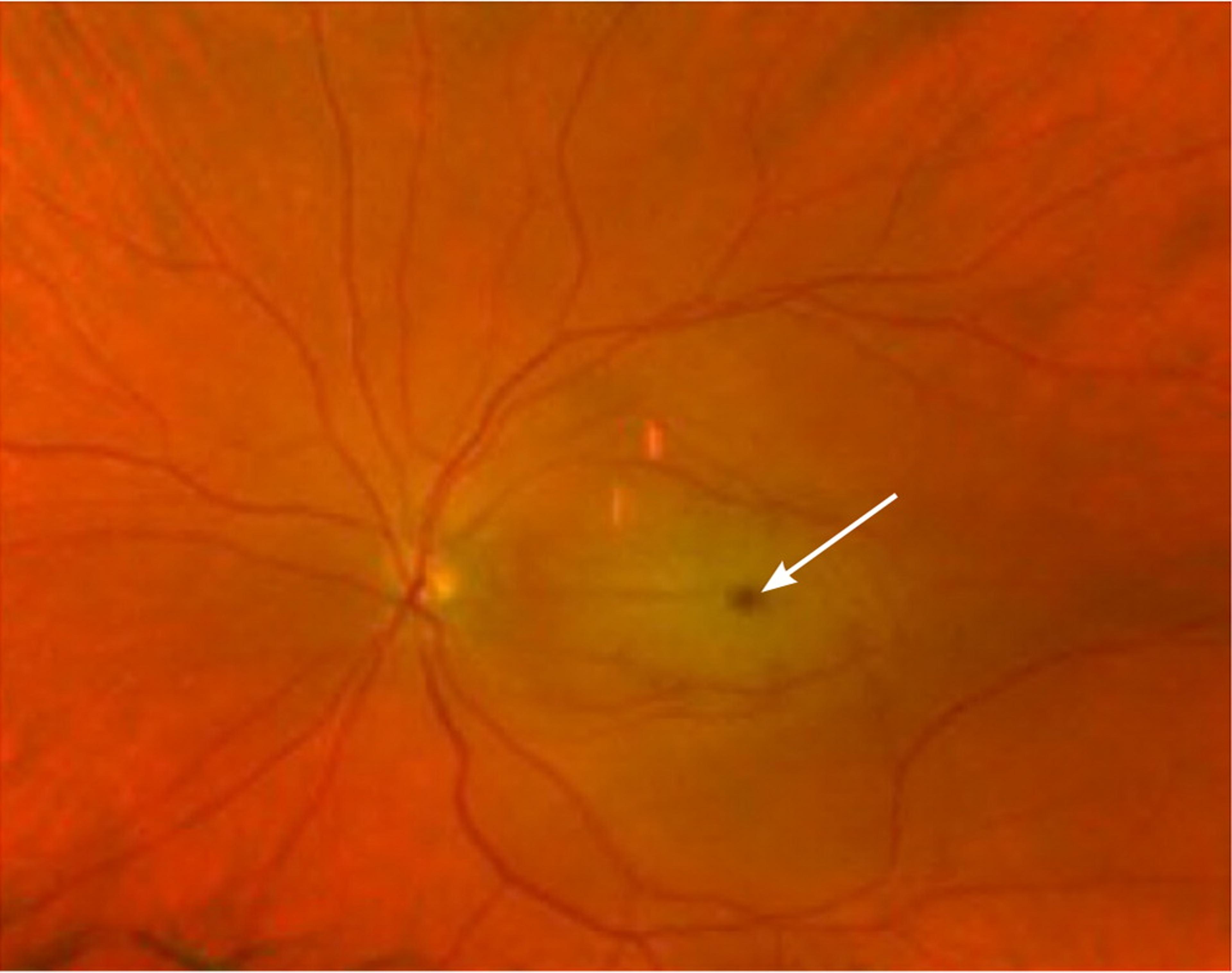 Funduscopic view of the eye demonstrating a central retinal artery occlusion with a cherry-red spot (arrow) in the fovea indicating retinal ischemia.