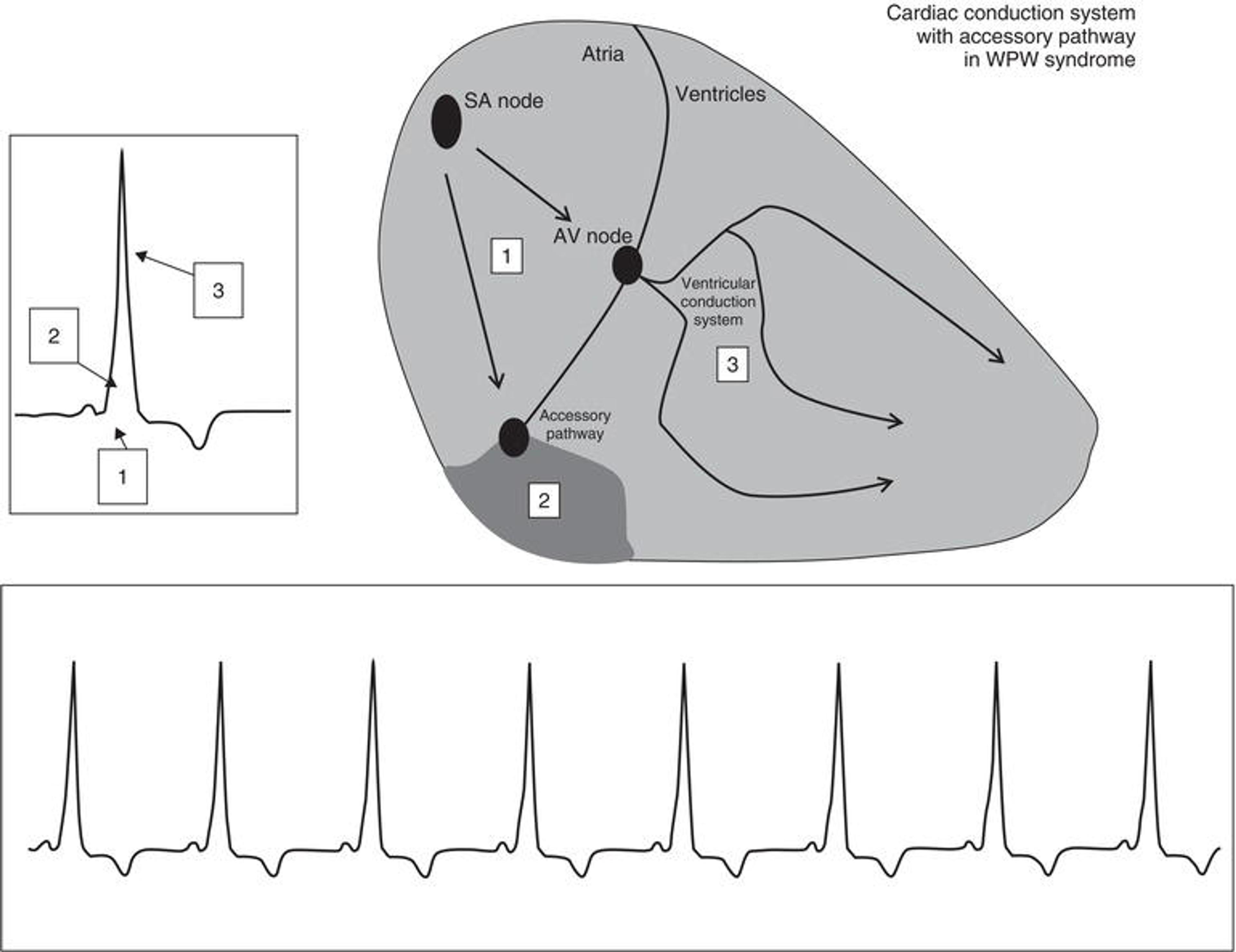 Figure 1. The ECG in the patient with WPW syndrome while in normal sinus rhythm ( NSR ). Note the classic triad of ECG findings, including the shortened PR interval (denoted by “1”), the delta wave (the initial slurring of the QRS complex, “2”), and the minimally widened QRS complex (“3”). While in NSR, the impulse travels through the atrial tissues and is transmitted to the ventricle via both the AV node and accessory pathway. The impulse arrives earlier than anticipated to the ventricular myocardium thus the PR interval is shorter (“1”) than the normal lower range of 0.12 seconds. The impulse travels into the ventricle via both the AV node and accessory pathway. The portion of the ventricular myocardium that depolarizes as a result of the impulse traveling through the accessory pathway is manifested on the ECG by the delta wave (“2”). Then, as the impulse moves into the ventricle via the accessory pathway and intraventricular conduction system, the QRS complex is minimally widened (“3”). This widening results from the inefficient conduction of the accessory pathway‐transmitted impulse throughout the ventricular myocardium (i.e. the intraventricular conduction system is not used).