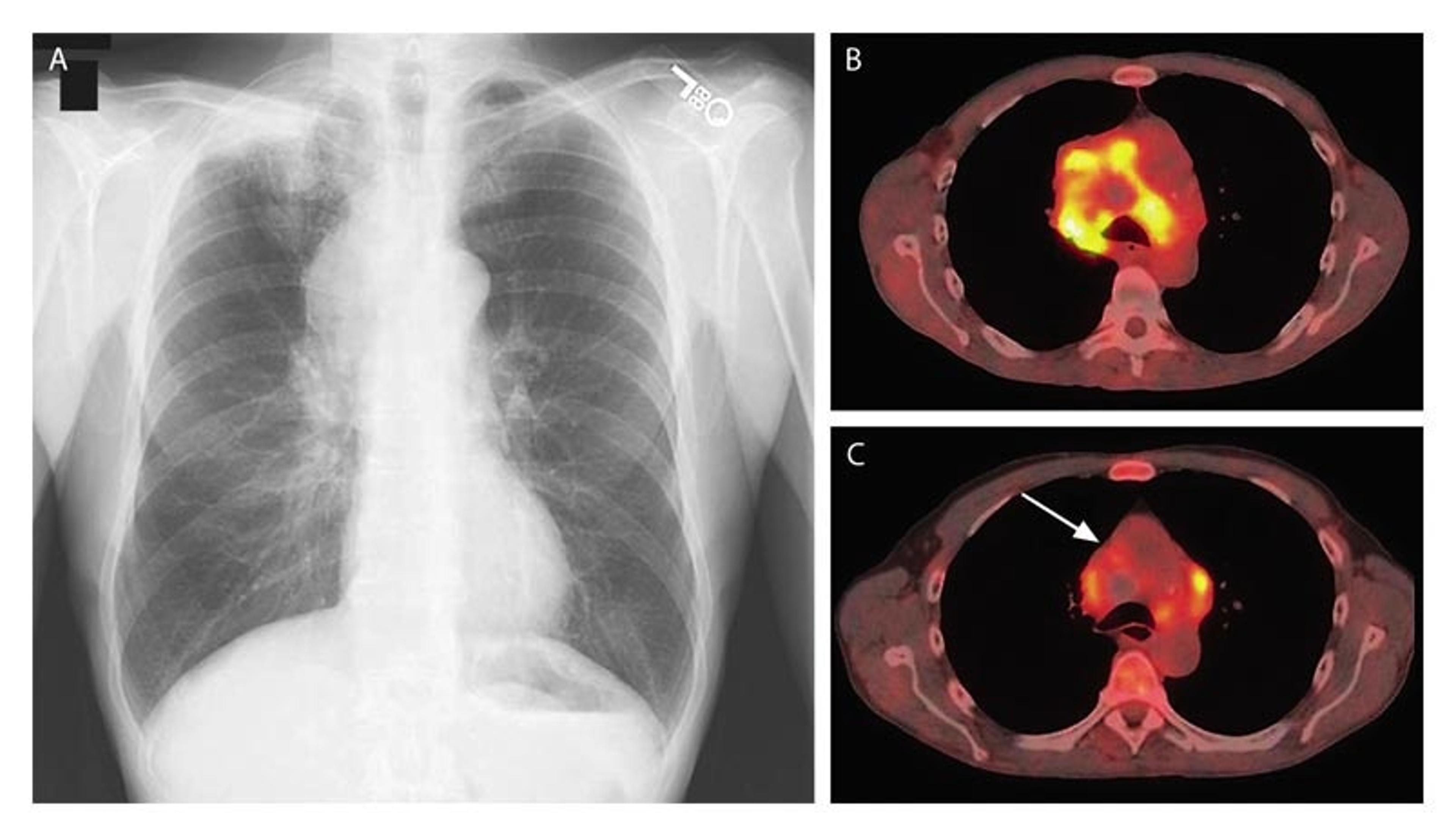 Chest Radiograph and PET–CT Scans of a Patient with the Superior Vena Cava Syndrome.