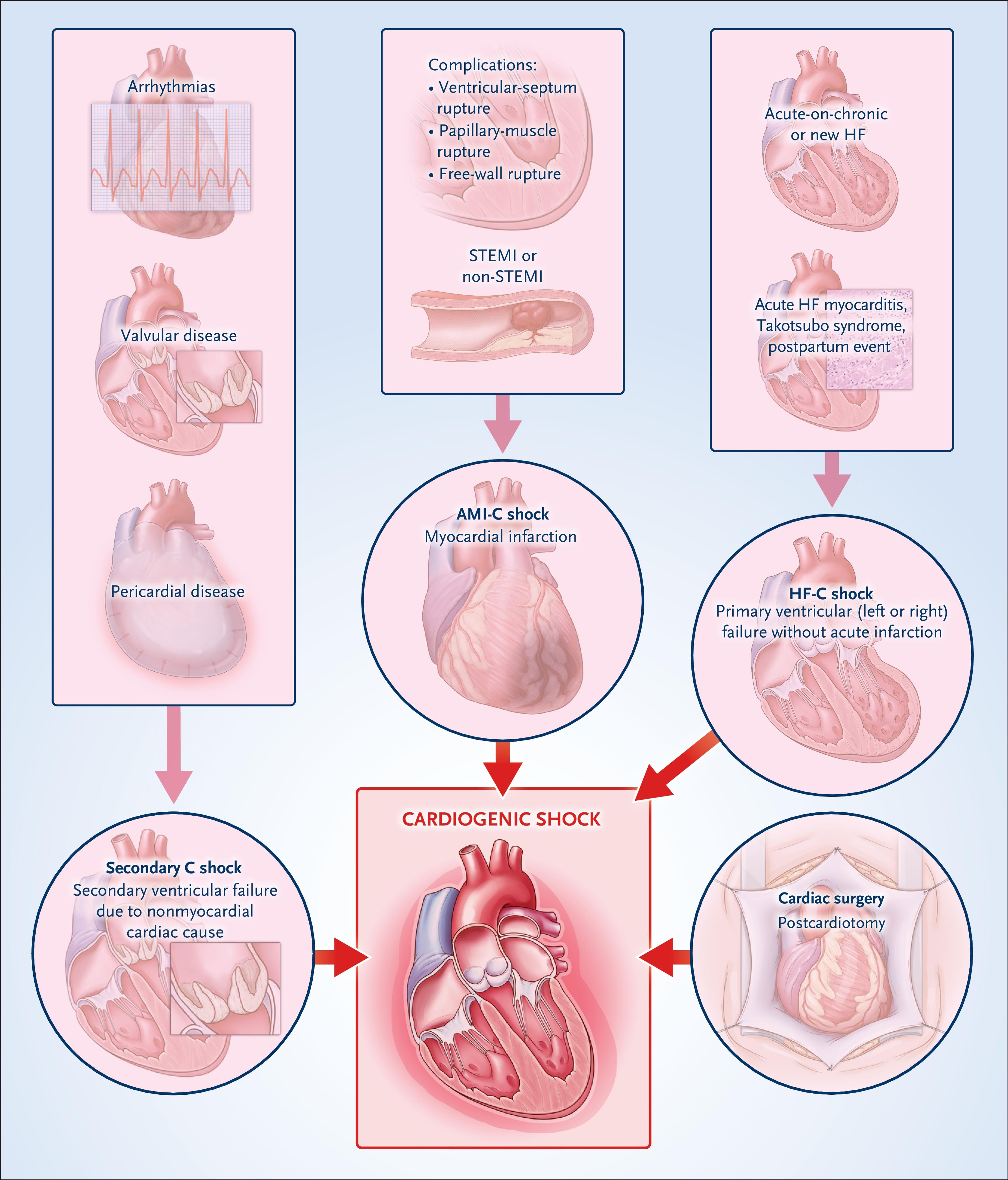 Causes of Cardiogenic Shock.