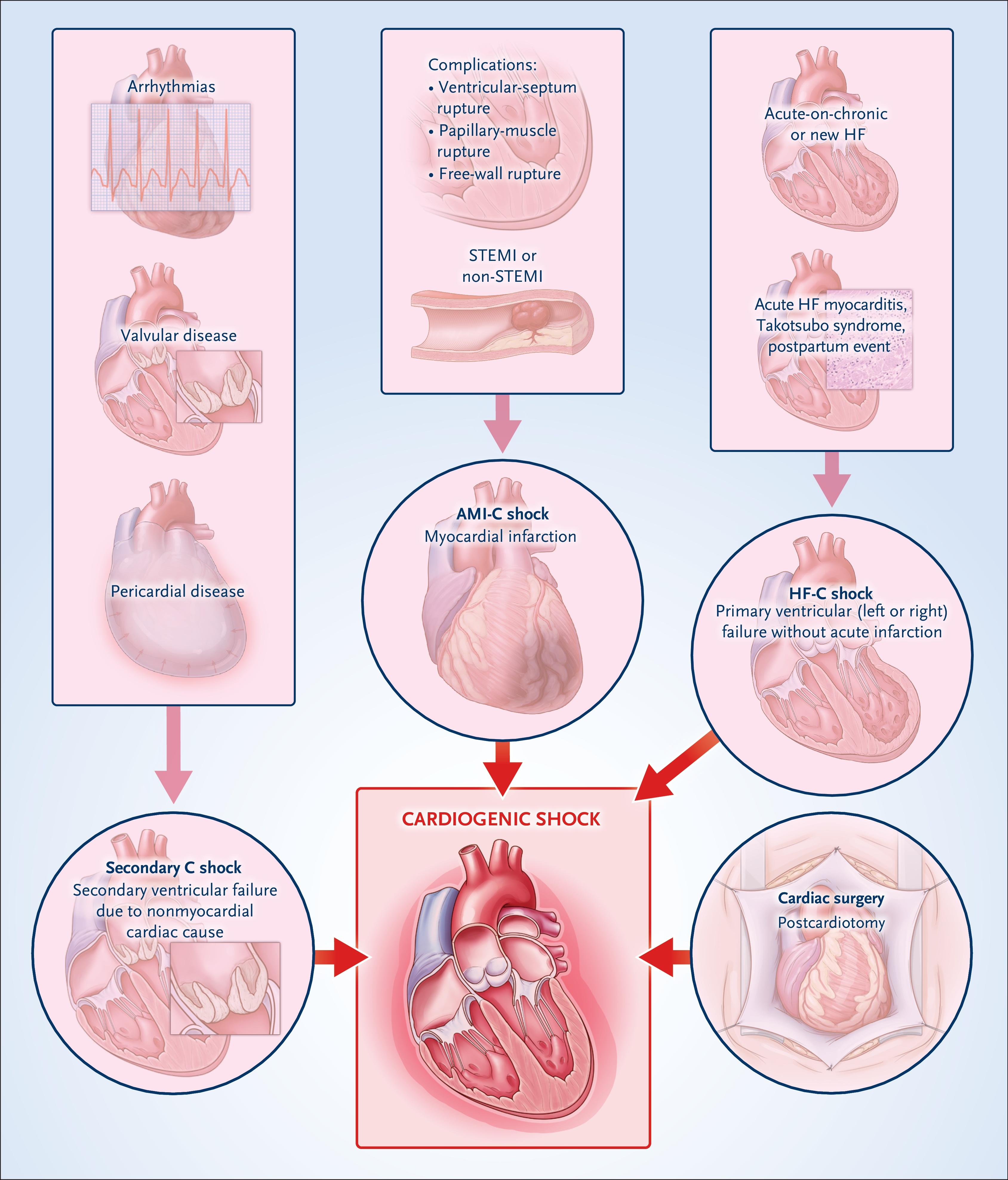Causes of Cardiogenic Shock.