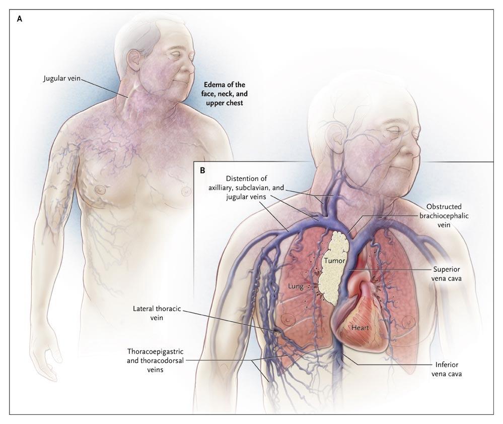 The Superior Vena Cava Syndrome.