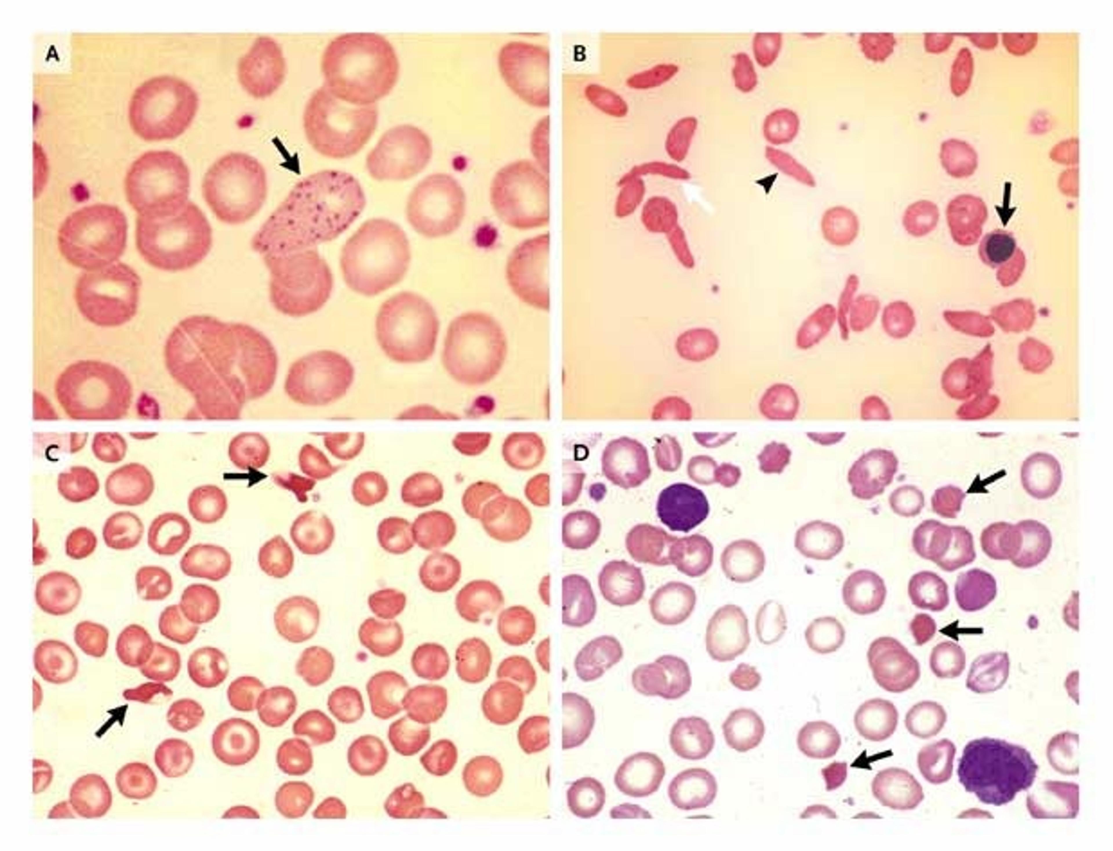 Red-Cell Changes with Lead Poisoning and in Hemoglobinopathies.