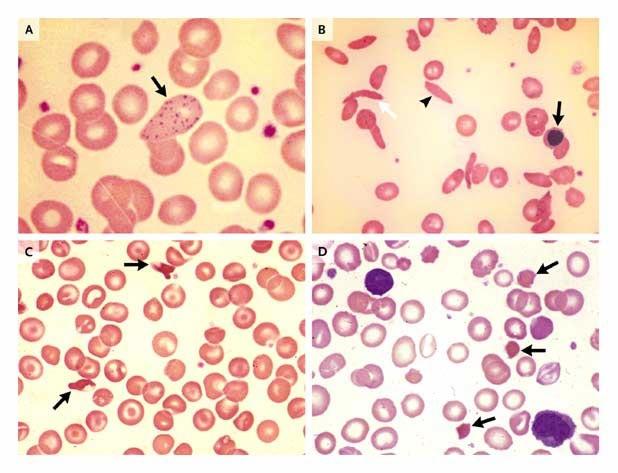 Red-Cell Changes with Lead Poisoning and in Hemoglobinopathies.
