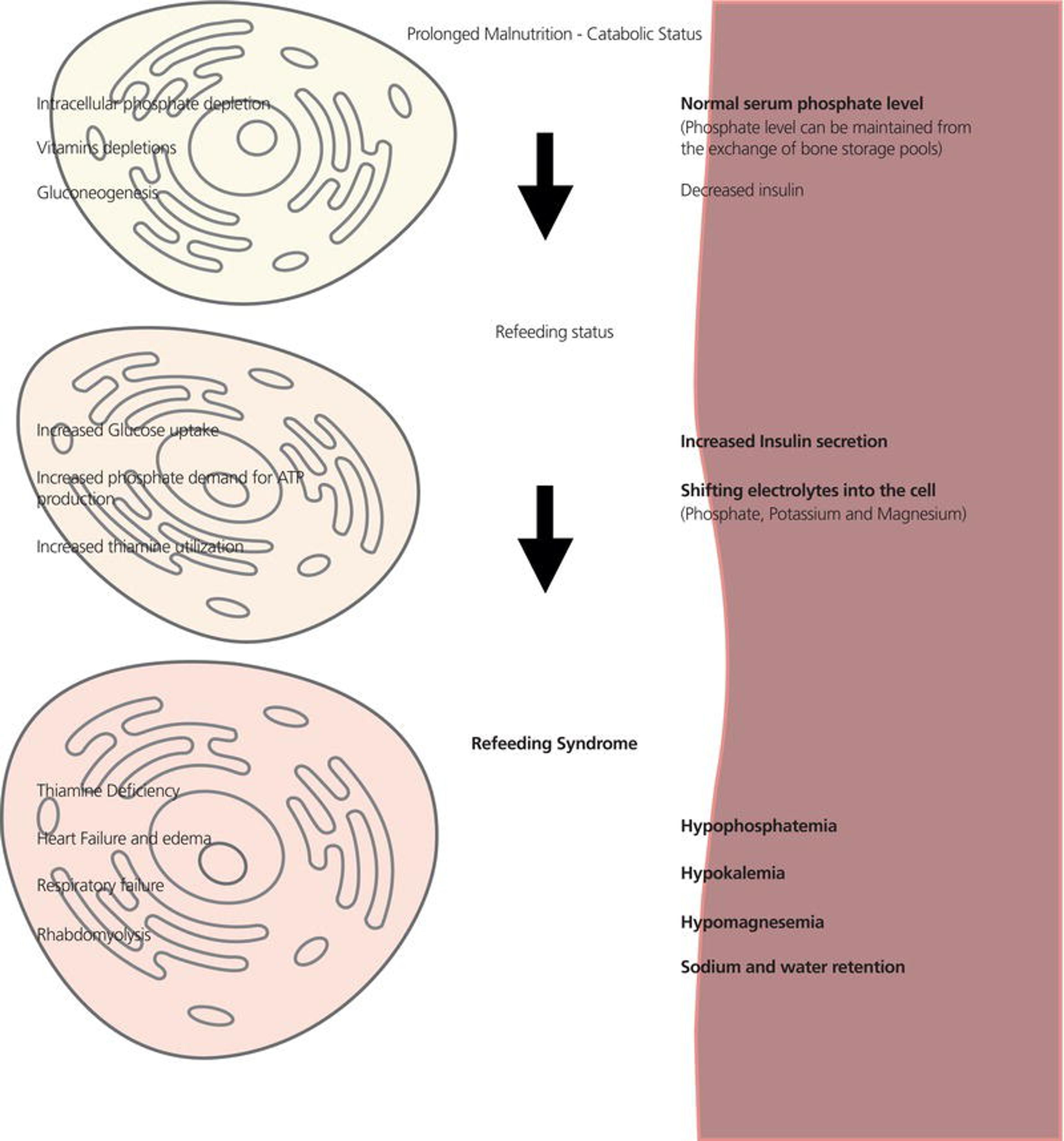 Pathogenesis of refeeding syndrome.