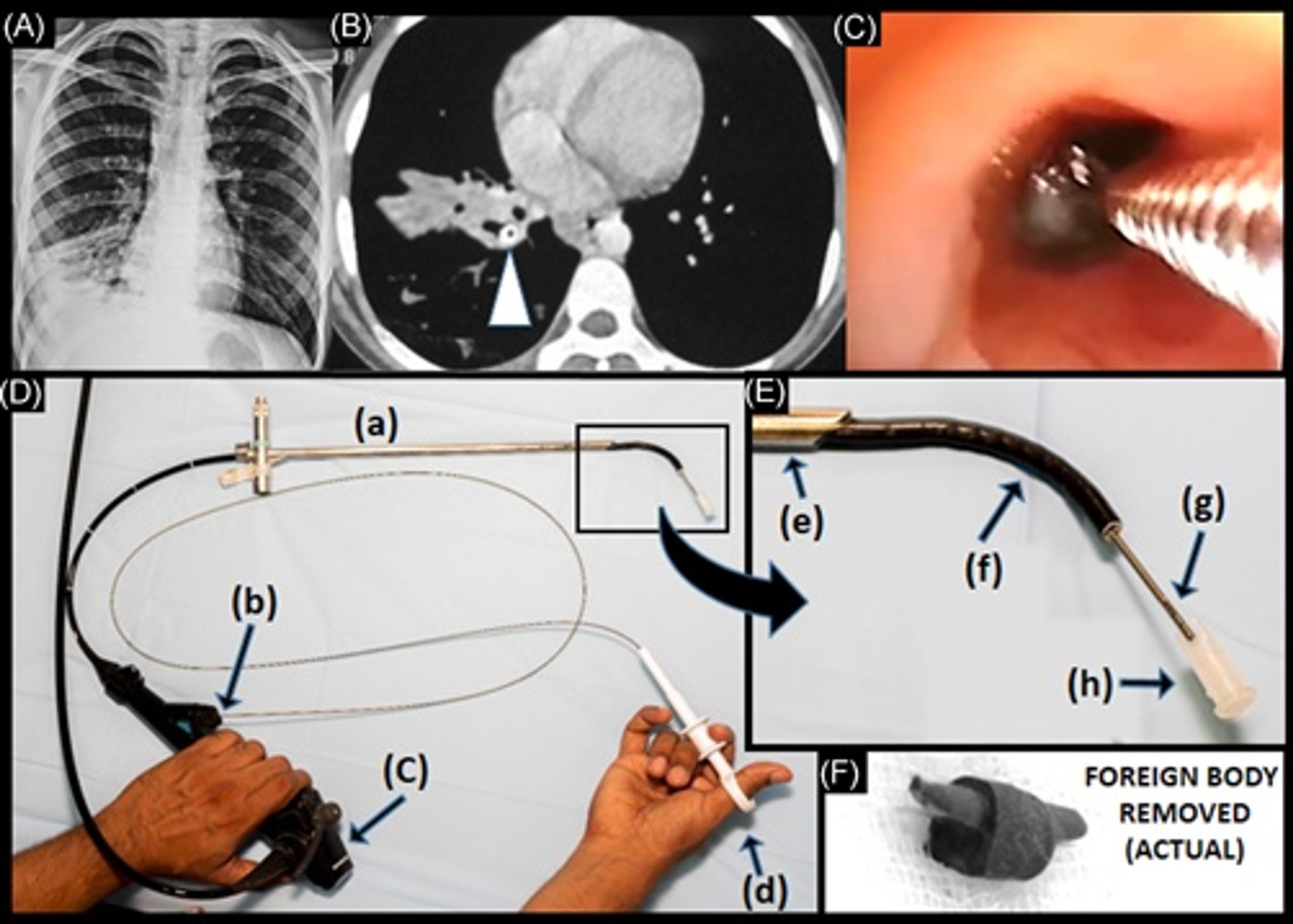 (A) Chest X‐ray: right lower lobe volume loss with cystic structures (some with air‐fluid levels).