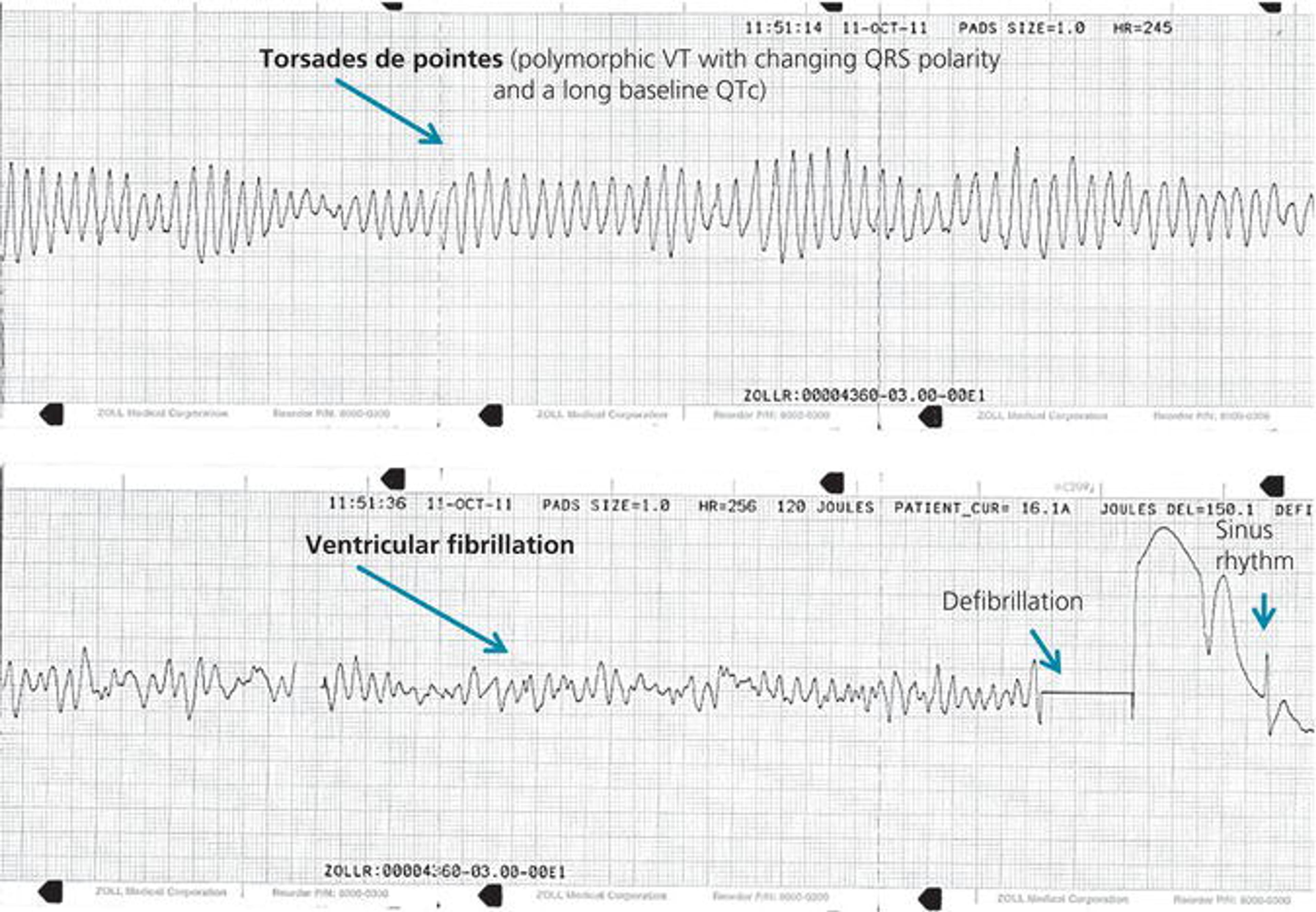 Torsades de pointes that degenerates into VF (same patient as Figure )