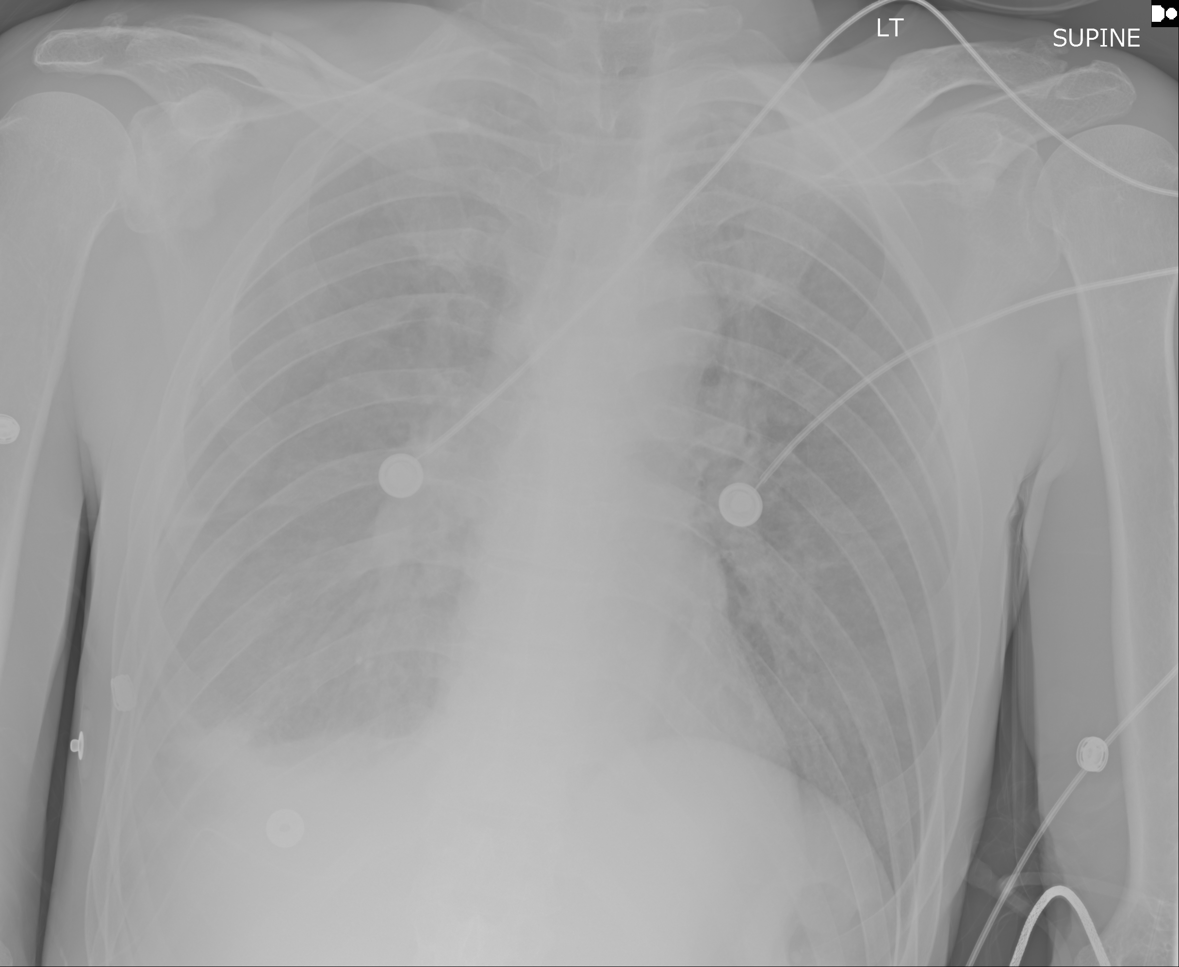 Acute right lateral fifth rib fracture and pulmonary contusion with right inferior thoracic opacities and pleural effusion.