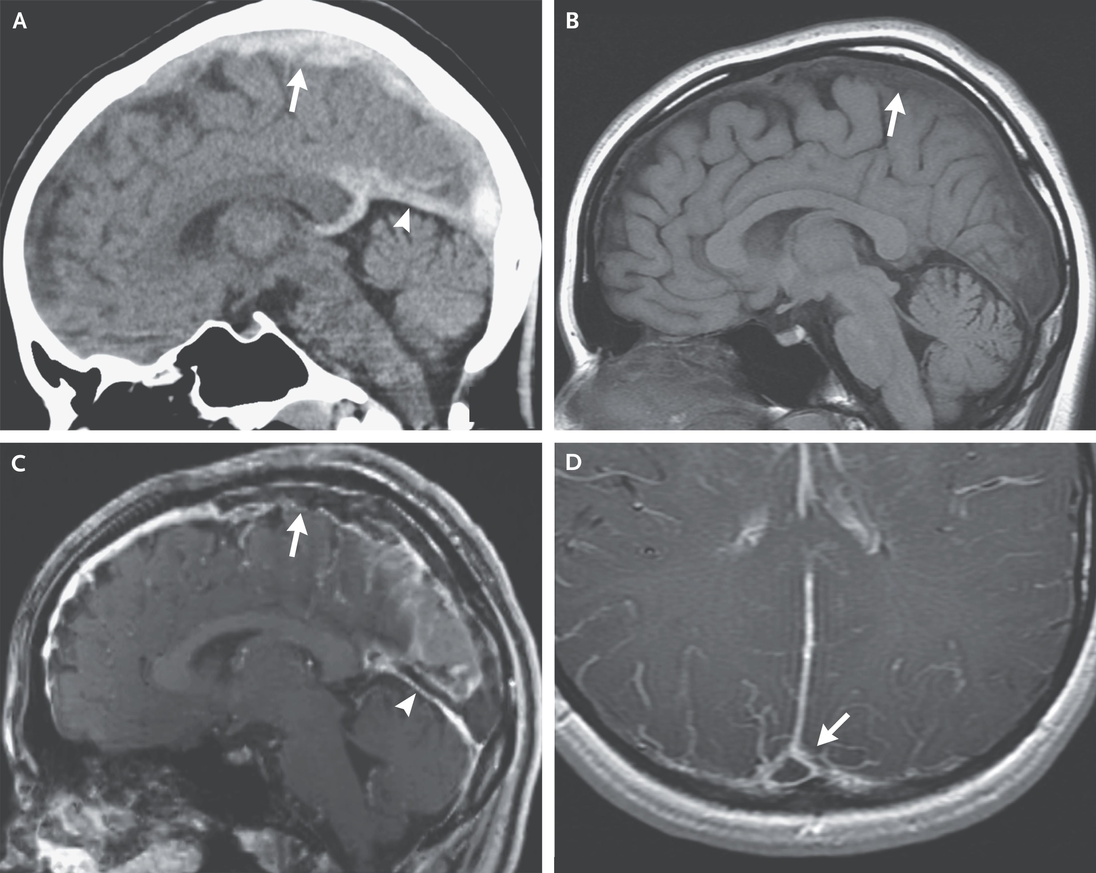 Imaging Studies of Venous Sinus Thrombosis.