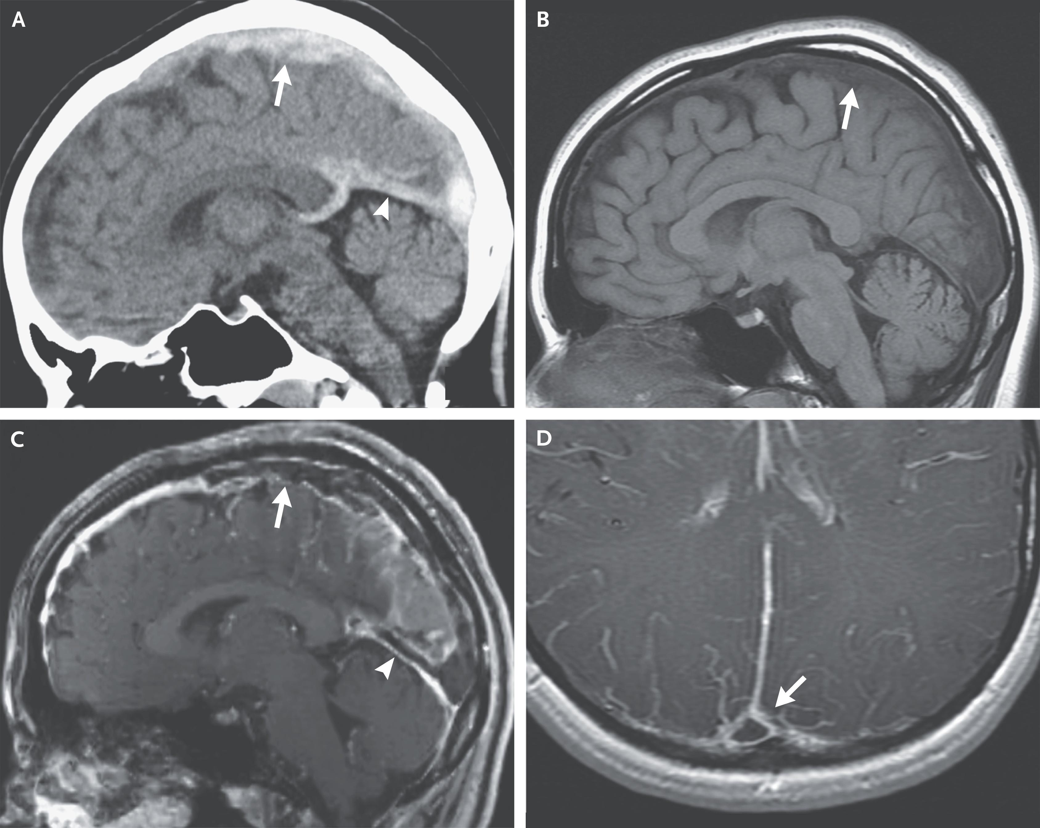 Imaging Studies of Venous Sinus Thrombosis.