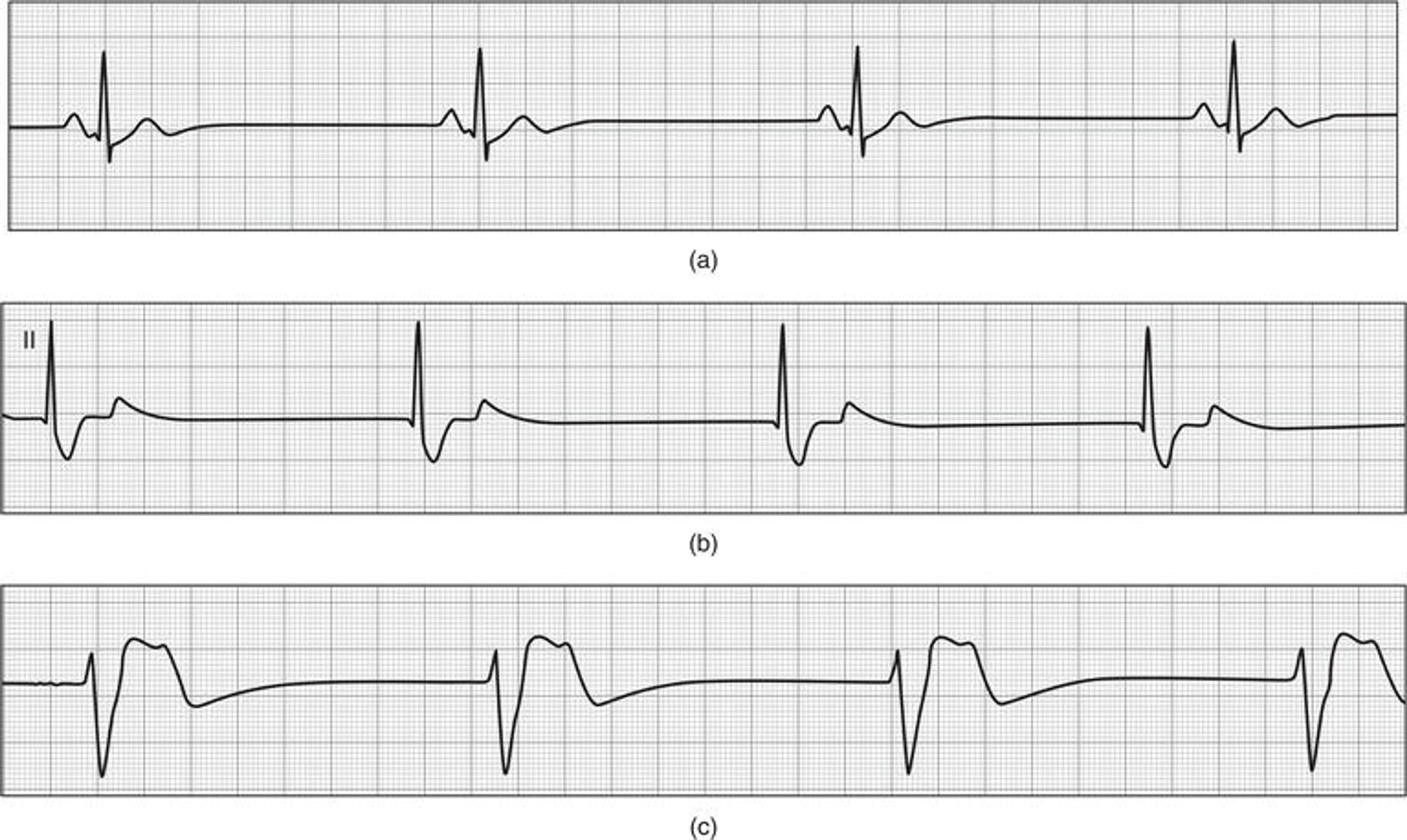Bradycardias. (a) Sinus bradycardia – criteria for sinus rhythm are present with the exception of a rate less than 60 bpm. (b) Junctional bradycardia – a regular, narrow QRS complex rhythm without evidence of obvious P waves. (c) Idioventricular bradycardia – a regular, wide QRS complex rhythm without evidence of P waves.