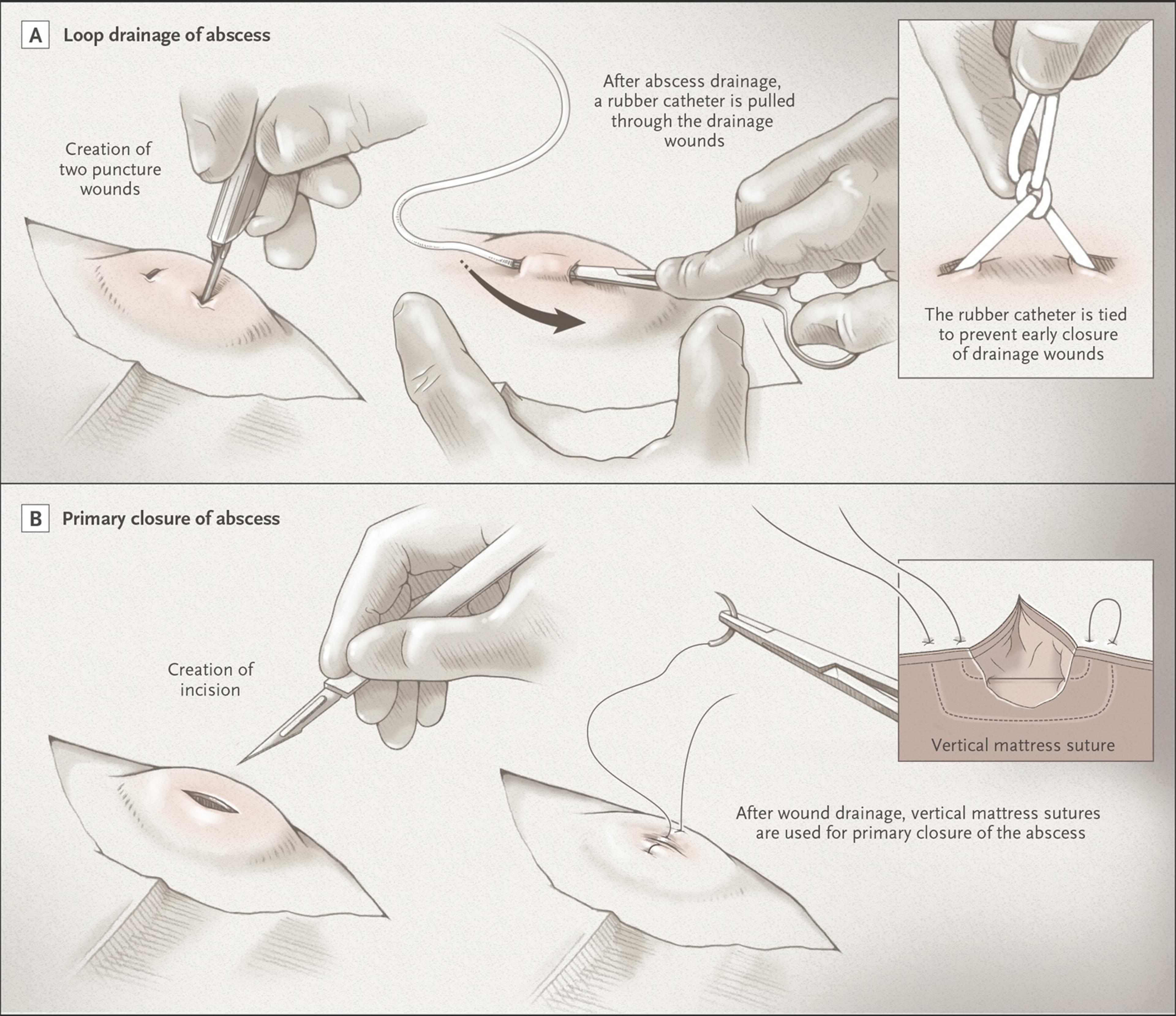 New Surgical Approaches to Abscess Treatment.