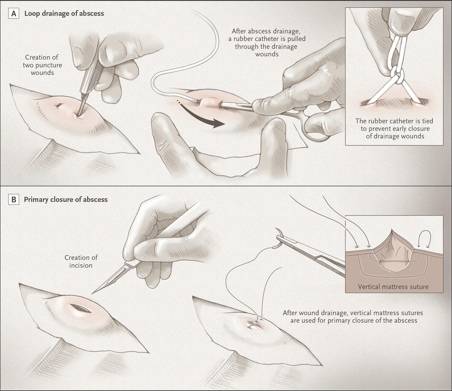 New Surgical Approaches to Abscess Treatment.