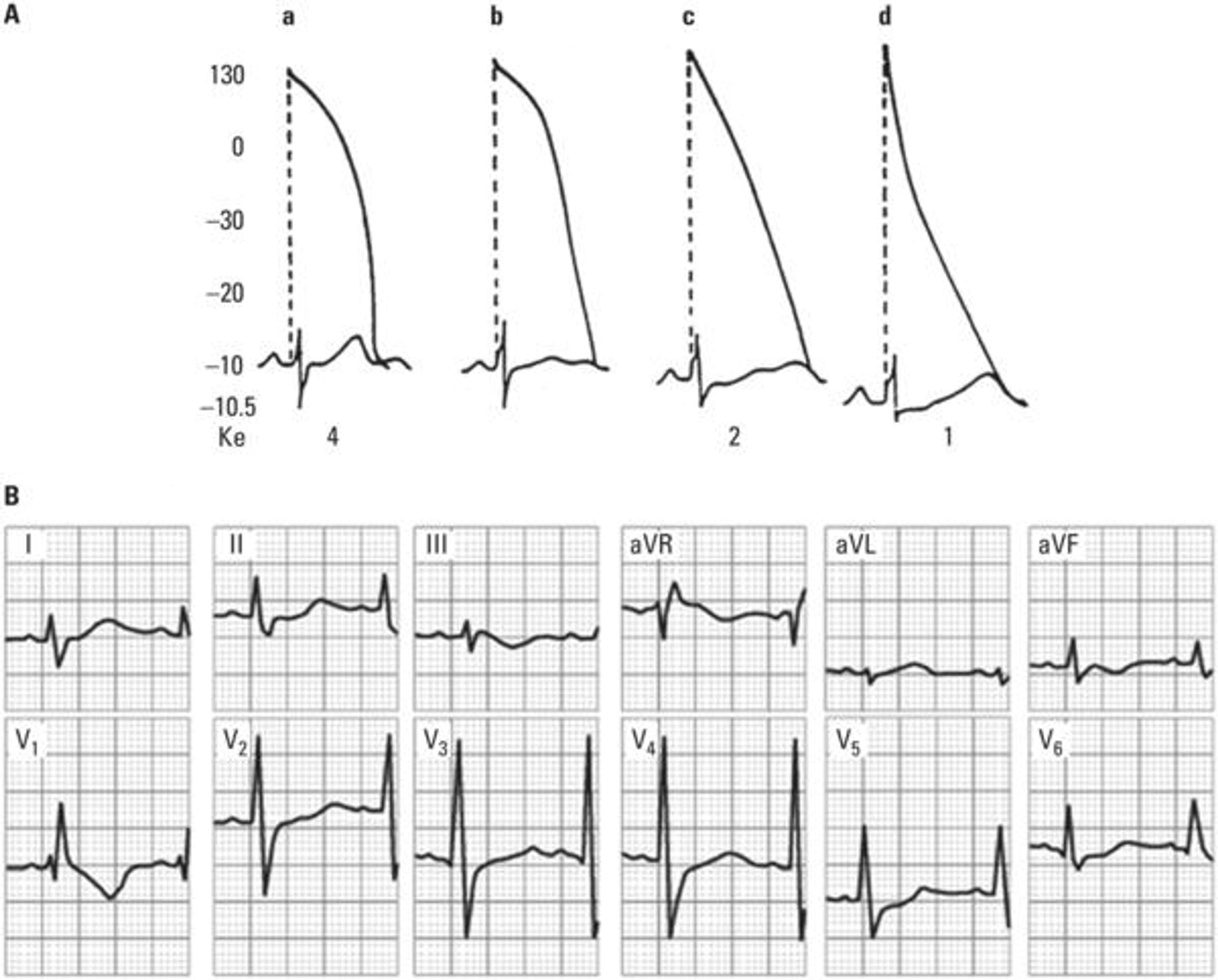 (A) Schematic representation of the ECG changes observed in the evolving stages of hypokalemia. The ventricular transmembrane action potential (TAP) has been drawn superimposed on the surface ECG. The diastolic transmembrane potential (DTP) value is to the left and the extracellular K + level is shown below. Note that as extracellular K + level progressively decreases, the ventricular TAP duration increases at the expense of the phase 3 velocity decrease. The U wave in the ECG tracing is gradually seen more clearly while the T wave tends to decrease, together with an apparent ST segment depression (adapted from Surawicz ). (B) This belongs to a 45‐year‐old patient with advanced mitroaortic heart valve disease treated with excessive doses of digitalis and diuretics. Extracellular K + level is 2.3 mEq/l. The ECG change corresponding to phase C of the scheme shown in Figure can be clearly seen, particularly in V2–V4.