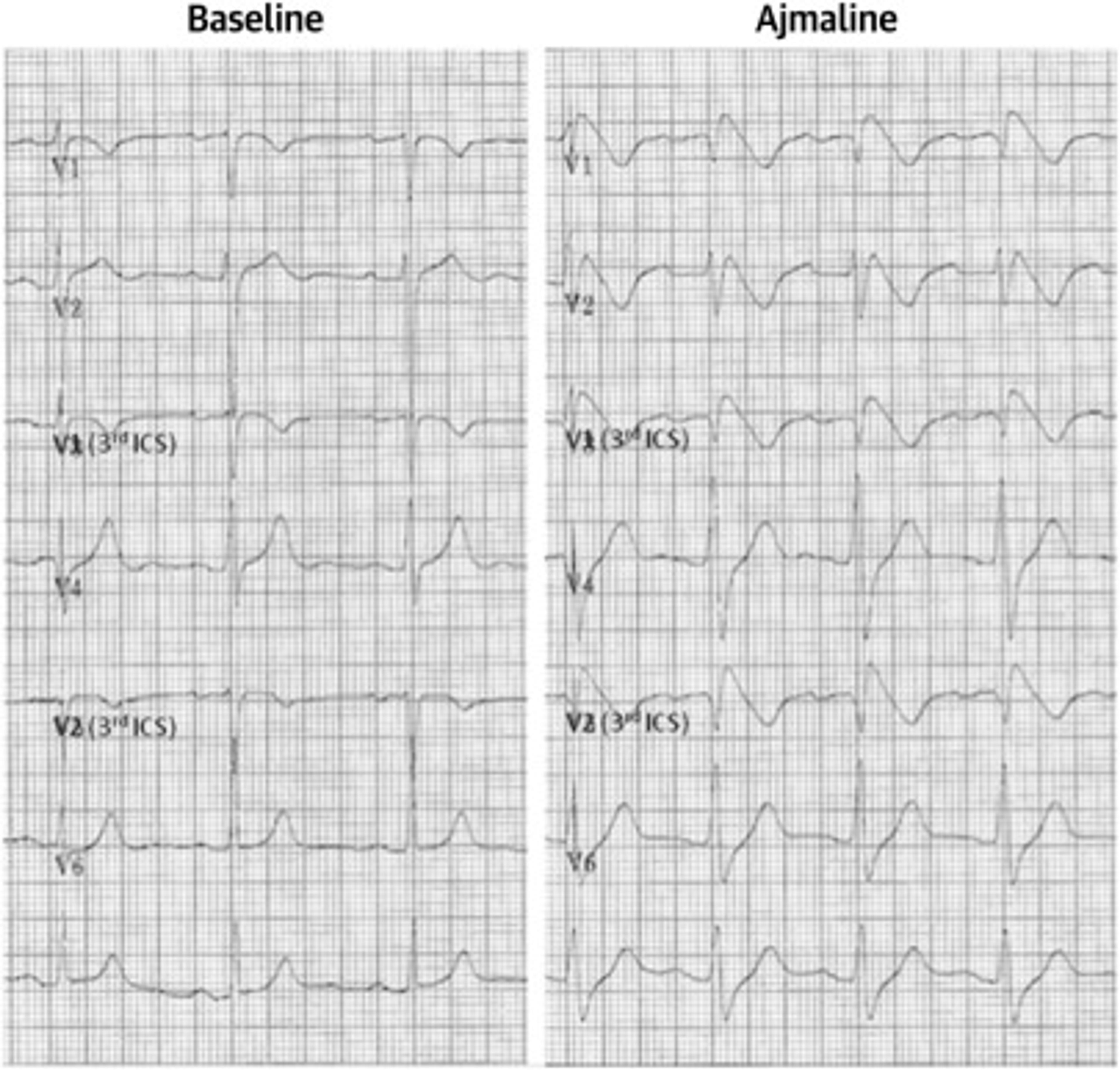 Electrocardiographic Pattern of Brugada Syndrome Induced By a Pharmacological Drug