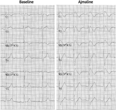 Electrocardiographic Pattern of Brugada Syndrome Induced By a Pharmacological Drug