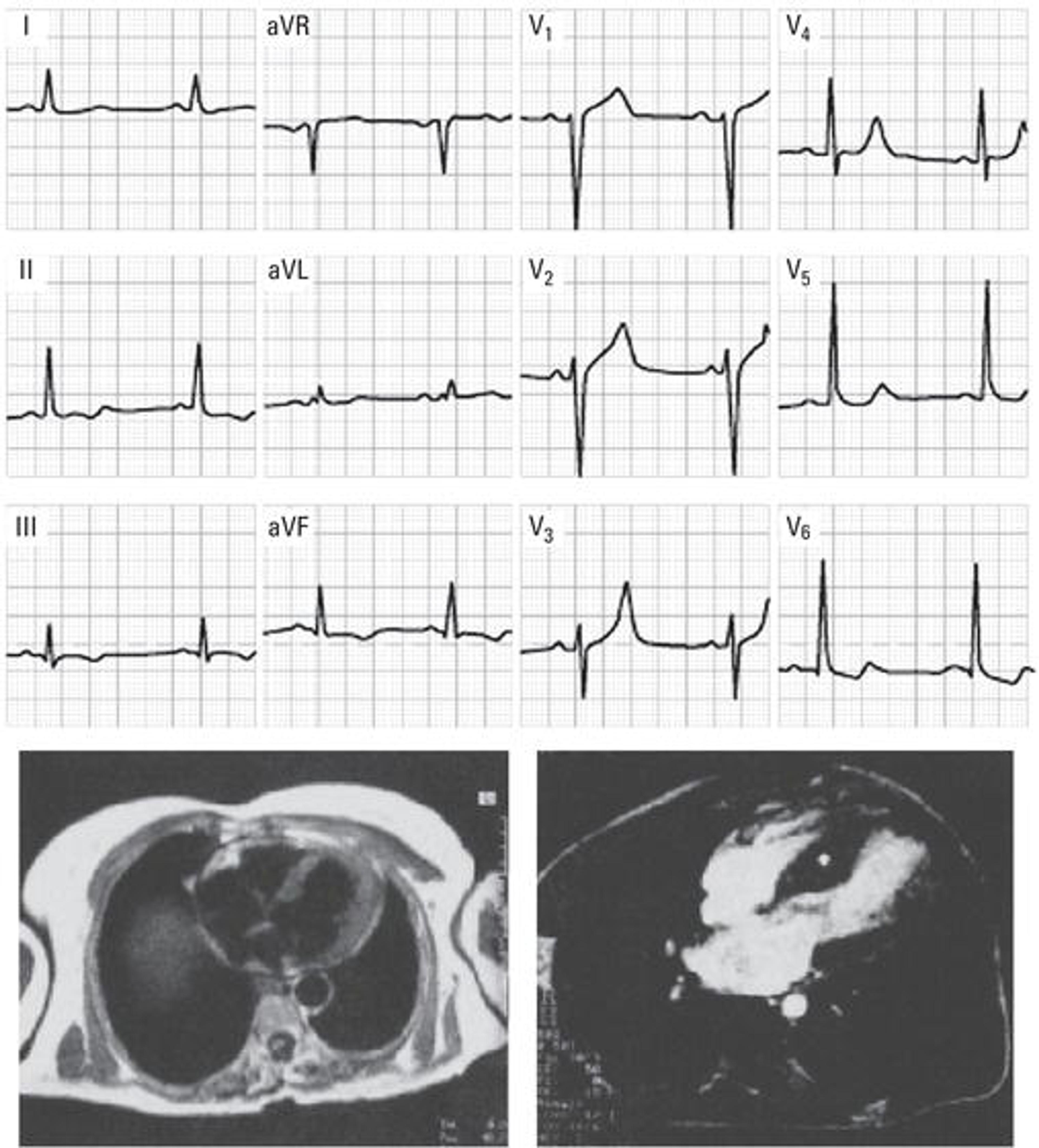 Top: ECG with left ventricular enlargement pattern not specific of any heart disease. Below: Cardiovascular magnetic resonance (CMR) (right) showing an asymmetric septal hypertrophy (asterisk), which confirms the diagnosis (HCM). Left: CMR with normal left ventricle image (for comparative purposes). It should be pointed out that echocardiography allows us to reach the same diagnosis.