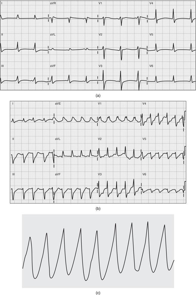 (a) Minimally widened QRS complex in the setting of a cardiotoxic ingestion with sodium channel blocking ability. (b) Tricyclic antidepressant overdose with characteristic changes on ECG, including sinus tachycardia, deep S wave in lead I, R wave in lead aVr, and widened QRS complex. (c) Ventricular tachycardia related to sodium channel blockade.