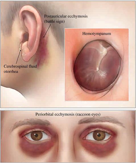 Findings suggestive of basilar skull fractures are Battle sign, hemotympanum, cerebrospinal fluid otorrhea, or raccoon eyes.
