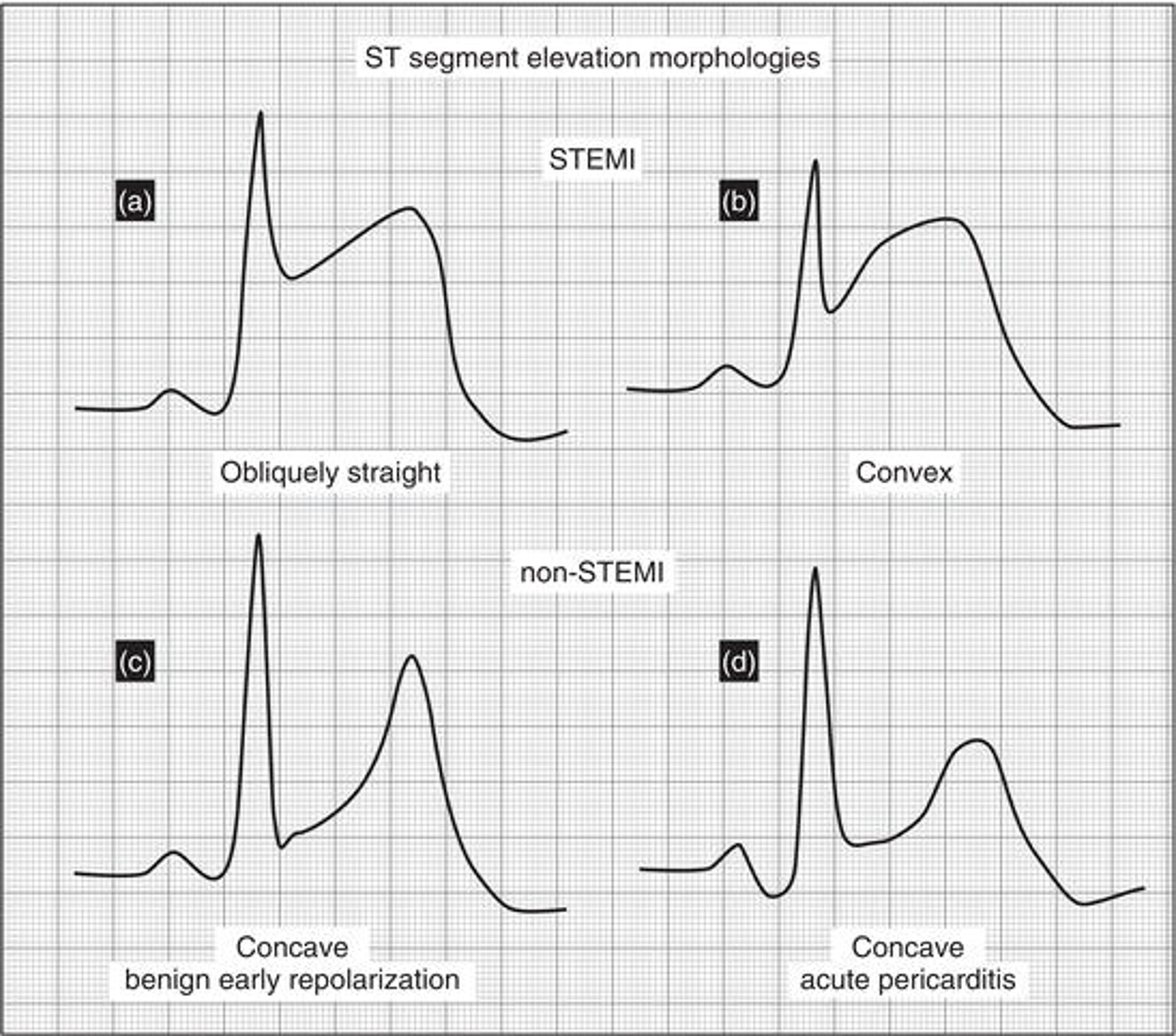 ST segment elevation subtypes in STEMI and non‐STEMI presentations. (a) STEMI with obliquely straight ST segment elevation; (b) STEMI with convex ST segment elevation; (c) non‐STEMI ( benign early repolarization , BER ) with concave ST segment elevation; (d) non‐STEMI (acute pericarditis) with concave ST segment elevation.
