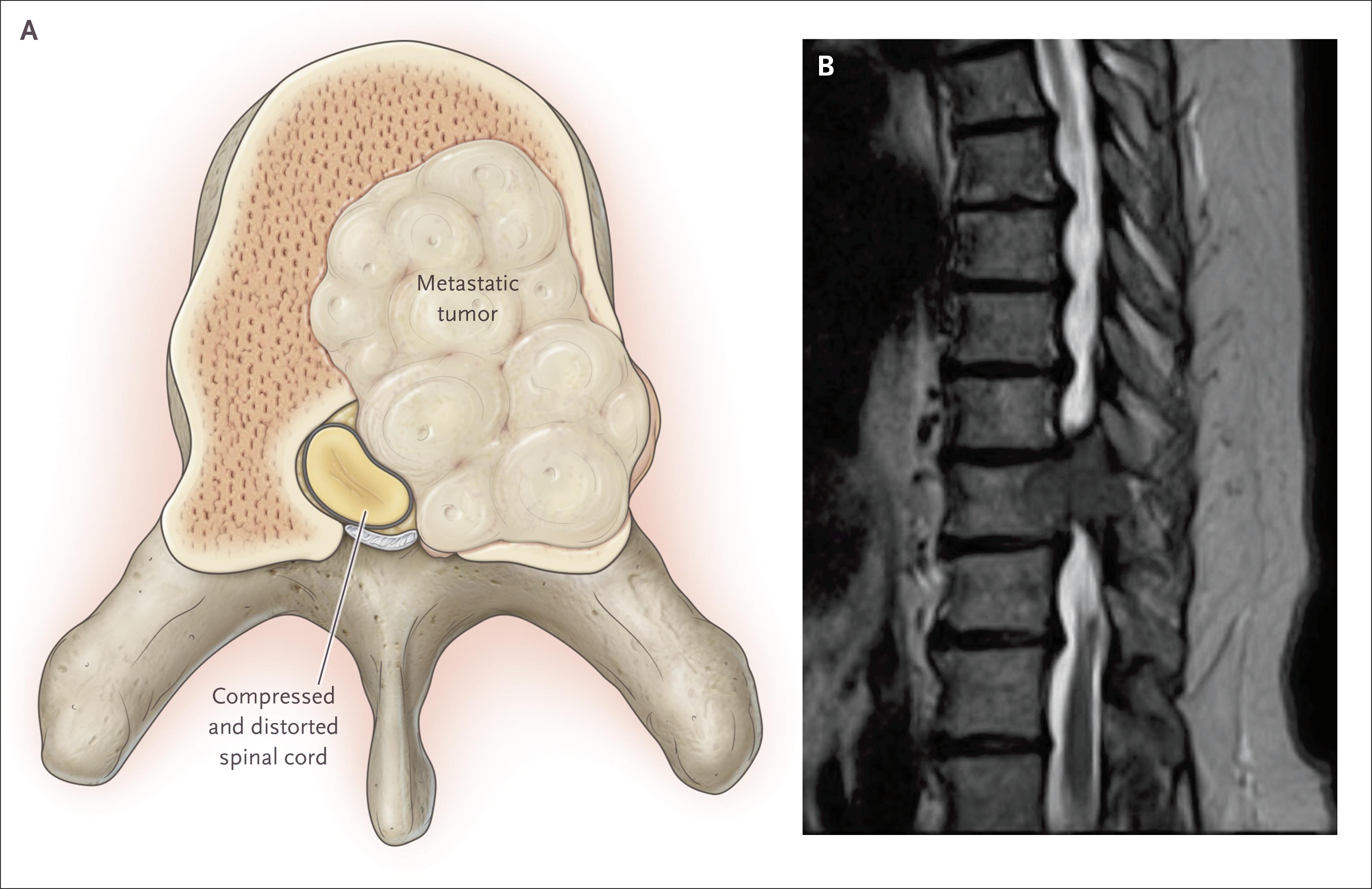 Acute Cord Compression Due to Metastatic Cancer to a Vertebral Body.