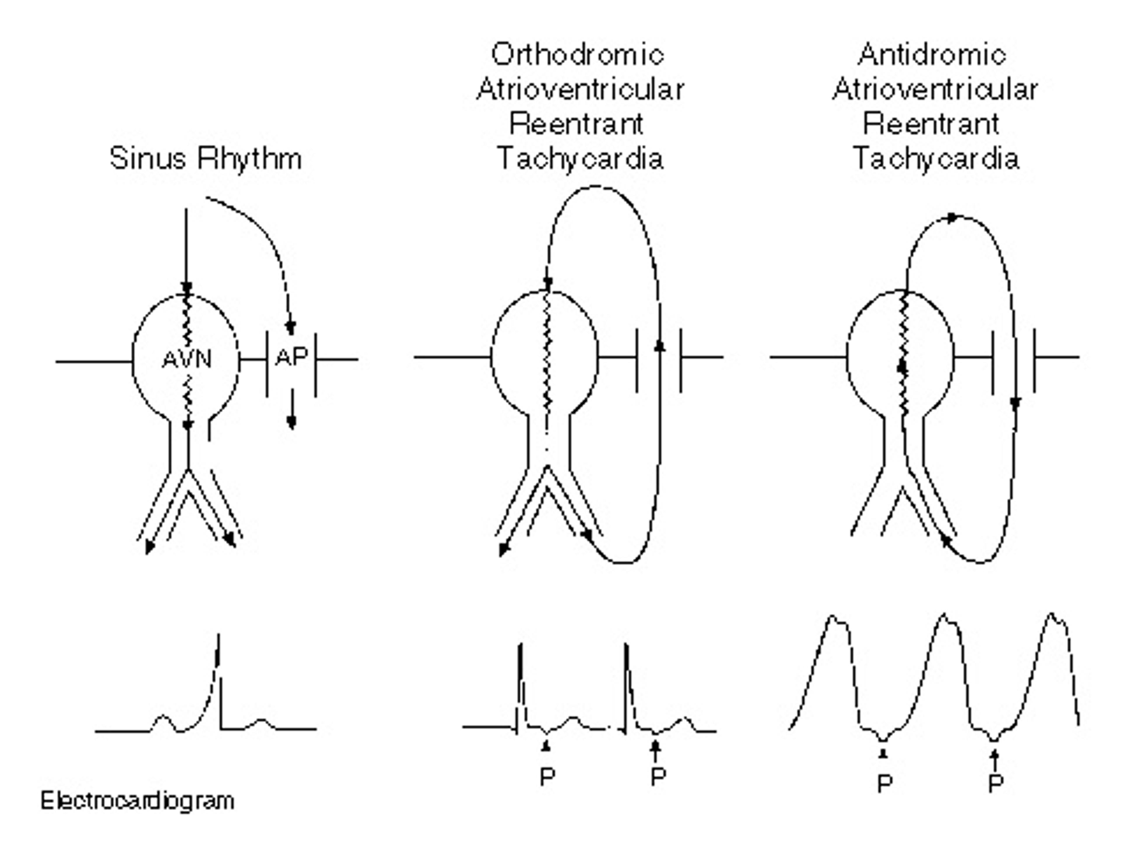 Figure 2. Mechanism of Atrioventricular Reentrant Tachycardia in Patients with the Wolff–Parkinson–White Syndrome.