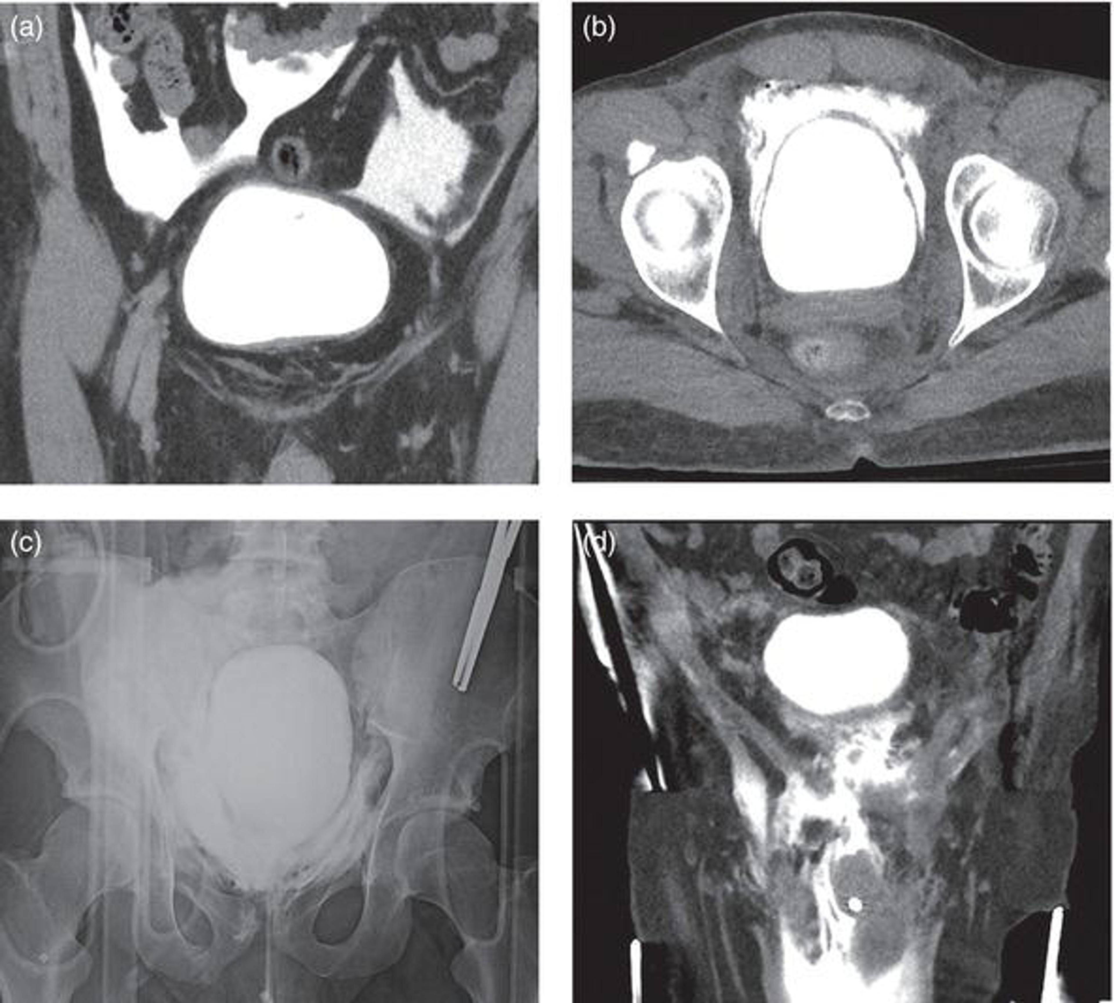 CT and fluoroscopic imaging of bladder rupture including: (a) coronal view of CT cystogram showing an intraperitoneal (IP) rupture with extravasated contrast outlining loops of bowel; (b) axial view of CT cystogram showing an EP bladder rupture with molar tooth extravasation pattern; (c) fluoroscopic cystogram showing an EP rupture with extravasation into the soft tissues of the pelvis; and (d): coronal view of CT cystogram showing an EP rupture with extensive extravasation tracking into the scrotum.