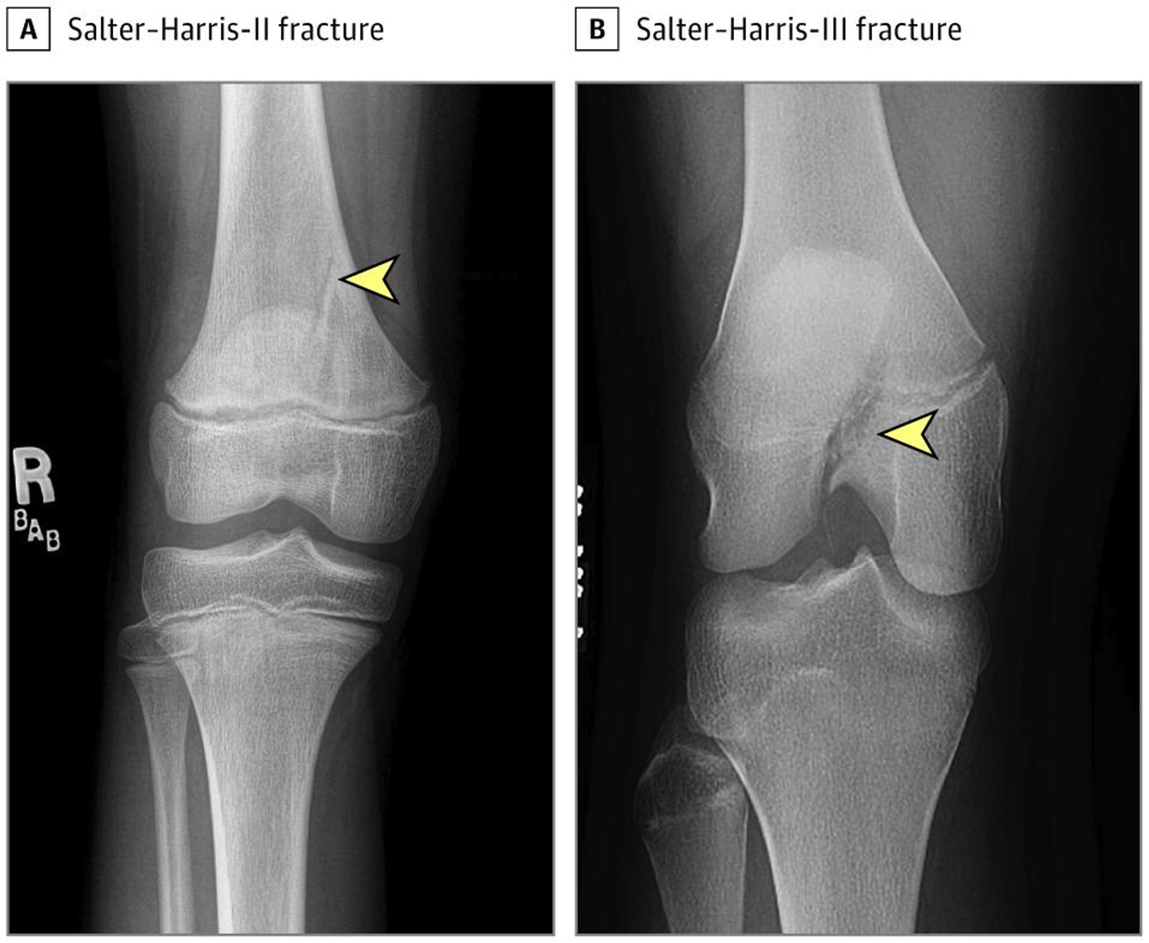 Salter-Harris (SH) Fracture Classification in the Distal Femur