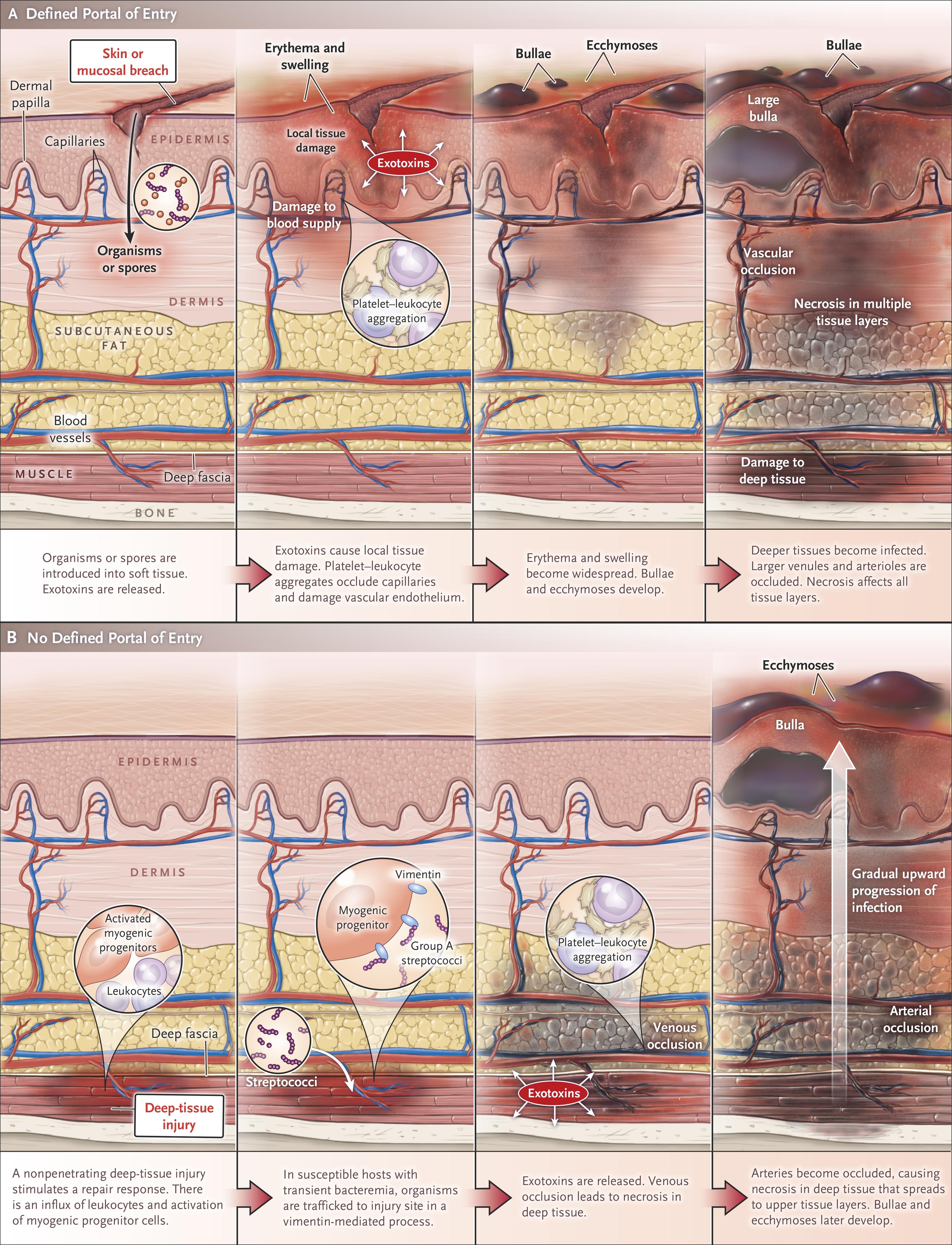 Evolution of Necrotizing Fasciitis or Myonecrosis.