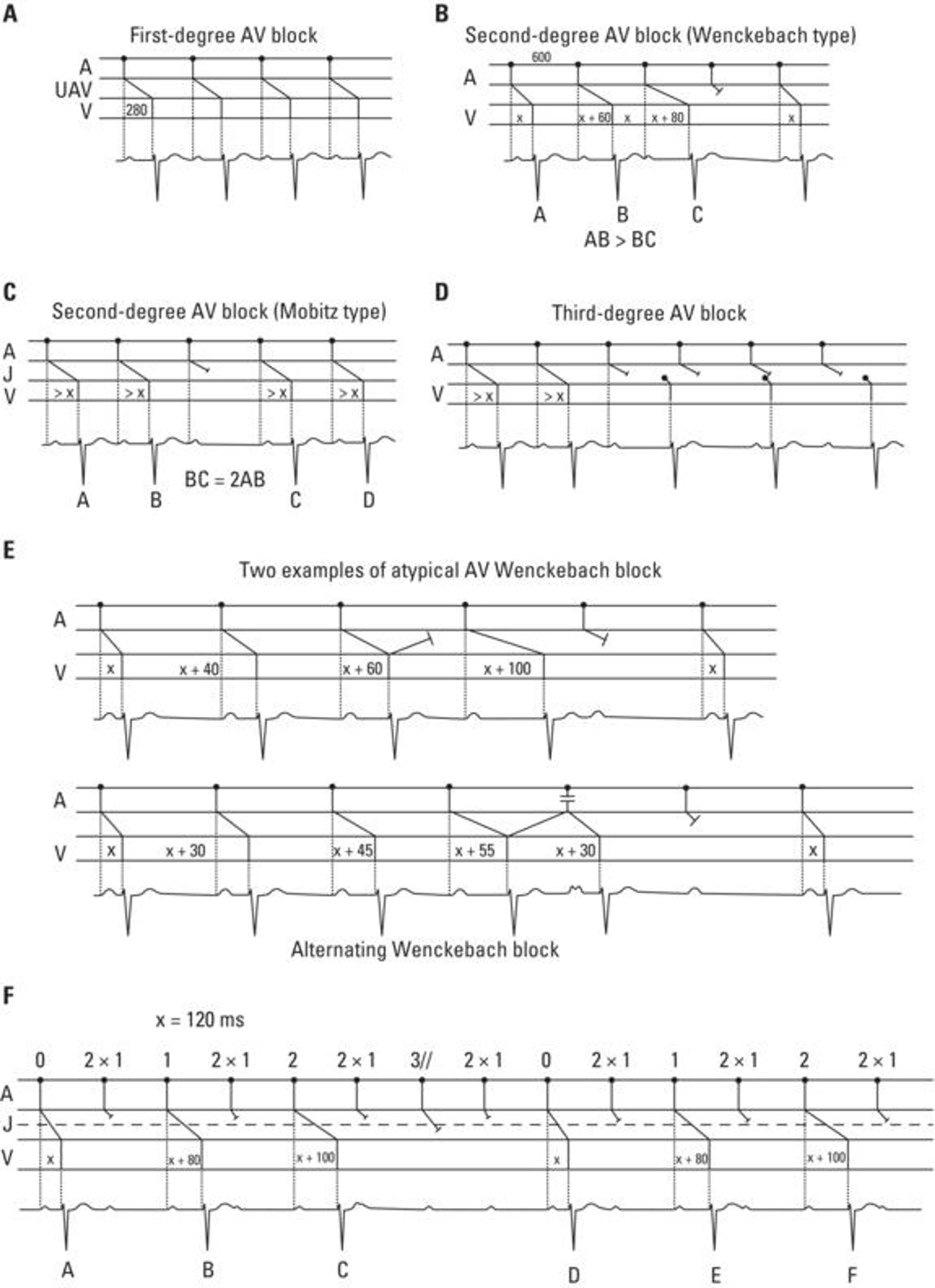 (A) First‐degree AV block. The PR interval is always prolonged (>200 ms); (B) second‐degree AV block 4 × 3 (Wenckebach type). The criterion AB > BC also applies in this case (see text and Figure B); (C) second‐degree AV block (Mobitz type) (BC = 2AB); (D) third‐degree AV block. A clear AV dissociation may be seen. After two QRS complexes have been conducted, there is a pause, followed by QRS (at slow frequencies) dissociated from P waves. In this case, the QRS complexes are junctional; (E) atypical Wenckebach blocks. Top: With abnormal lengthening of the increase preceding the pause (PR = x + 100) due to a concealed retrograde conduction of the preceding complex in the AV junction. Bottom: The abnormal PR shortening is due to the existence of a reciprocal complex in the AV junction; (F) example of an alternating Wenckebach block (see text).