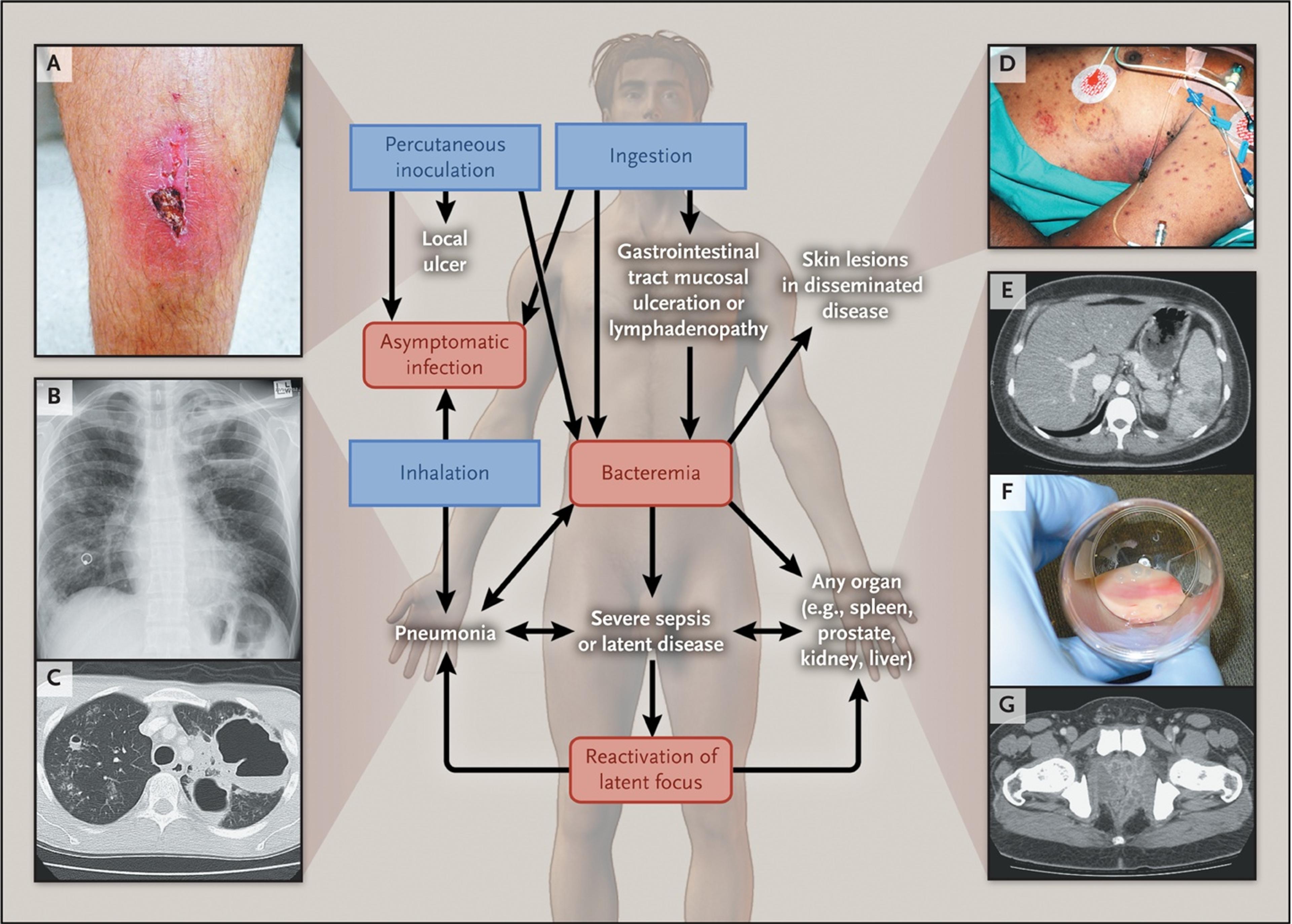 Clinical Events after Infection with B. pseudomallei.