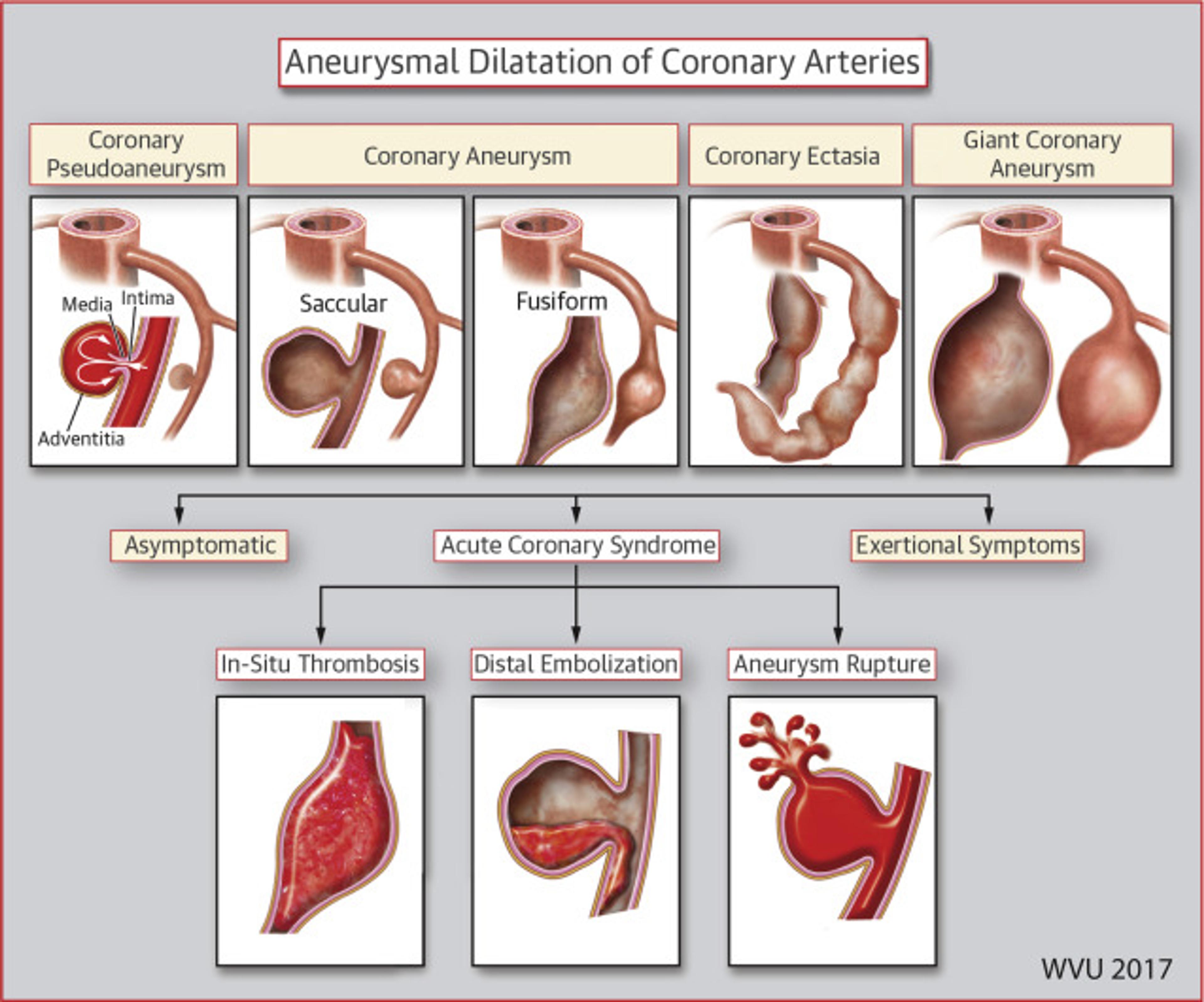 Illustration of the Variable Morphologies and Clinical Presentation of Aneurysmal Dilatation Involving Coronary Arteries
