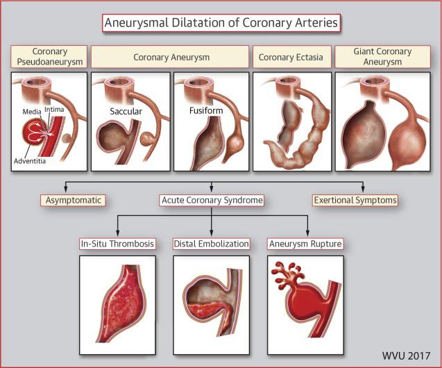 Illustration of the Variable Morphologies and Clinical Presentation of Aneurysmal Dilatation Involving Coronary Arteries