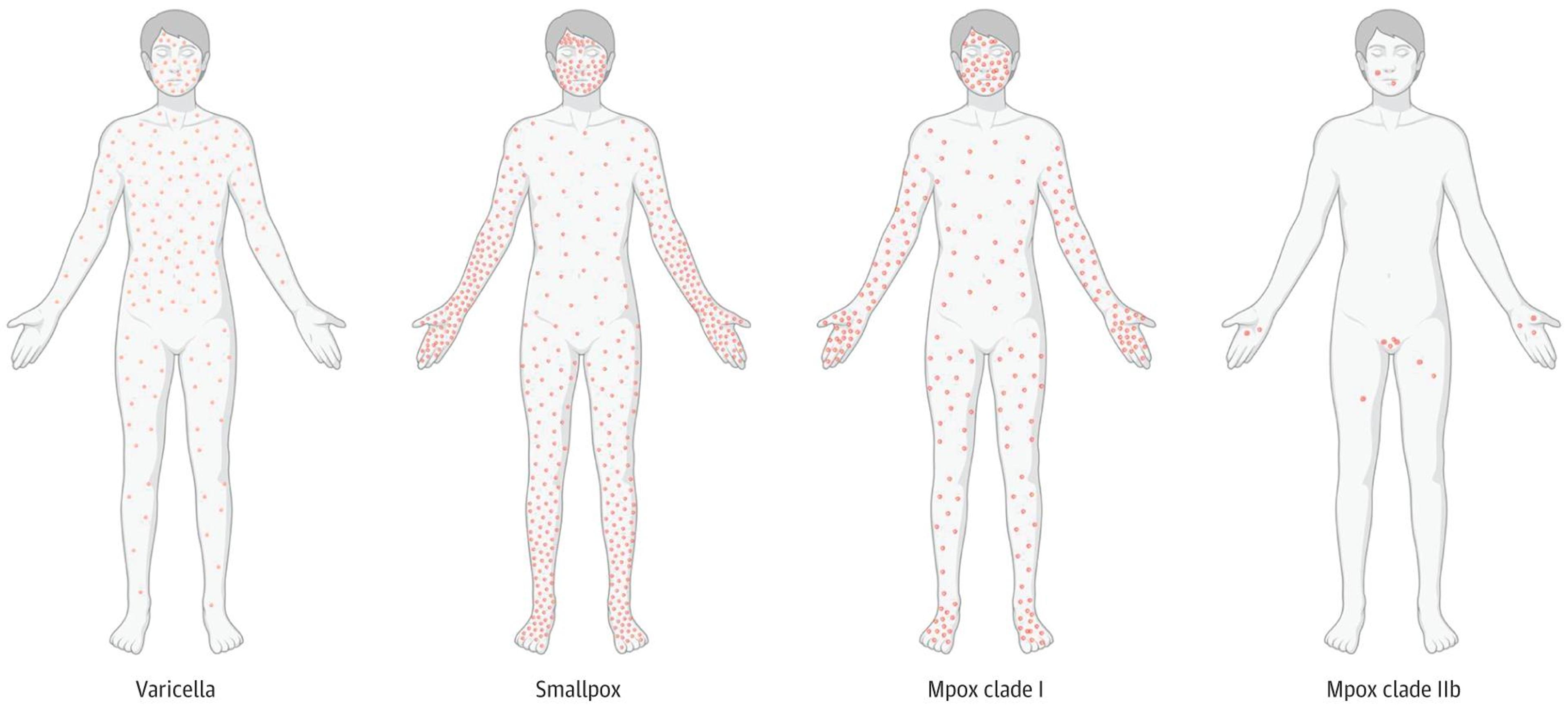Distribution of Skin Lesions in Primary Varicella, Smallpox, and Mpox Clade I and Clade IIb