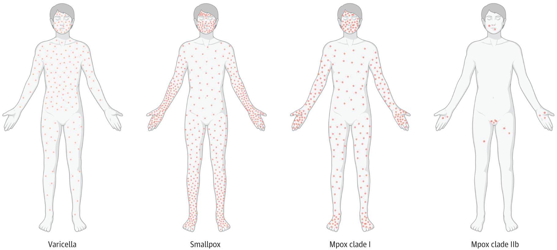 Distribution of Skin Lesions in Primary Varicella, Smallpox, and Mpox Clade I and Clade IIb