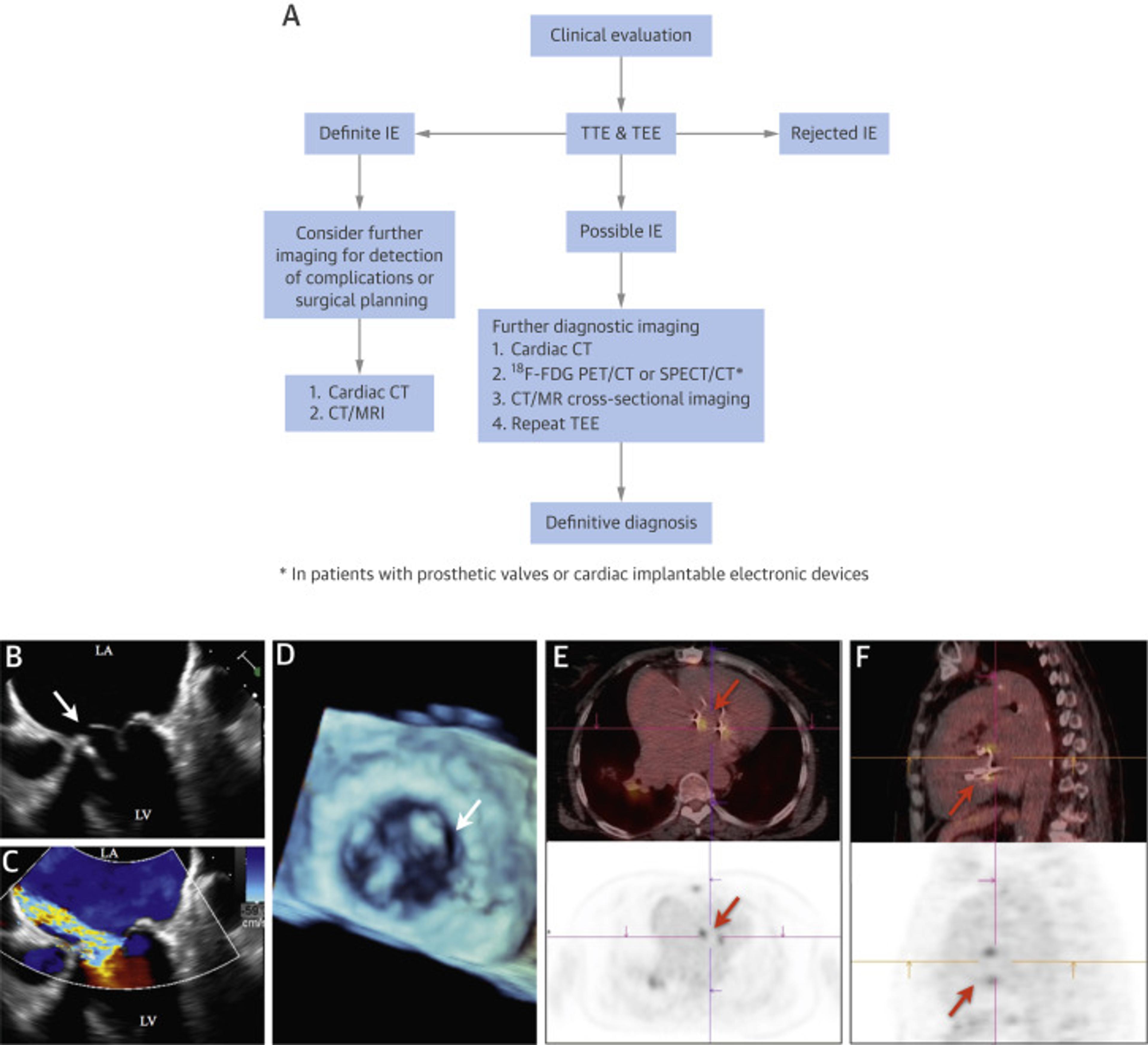 Integrated Imaging Strategy in Patients With Suspected IE