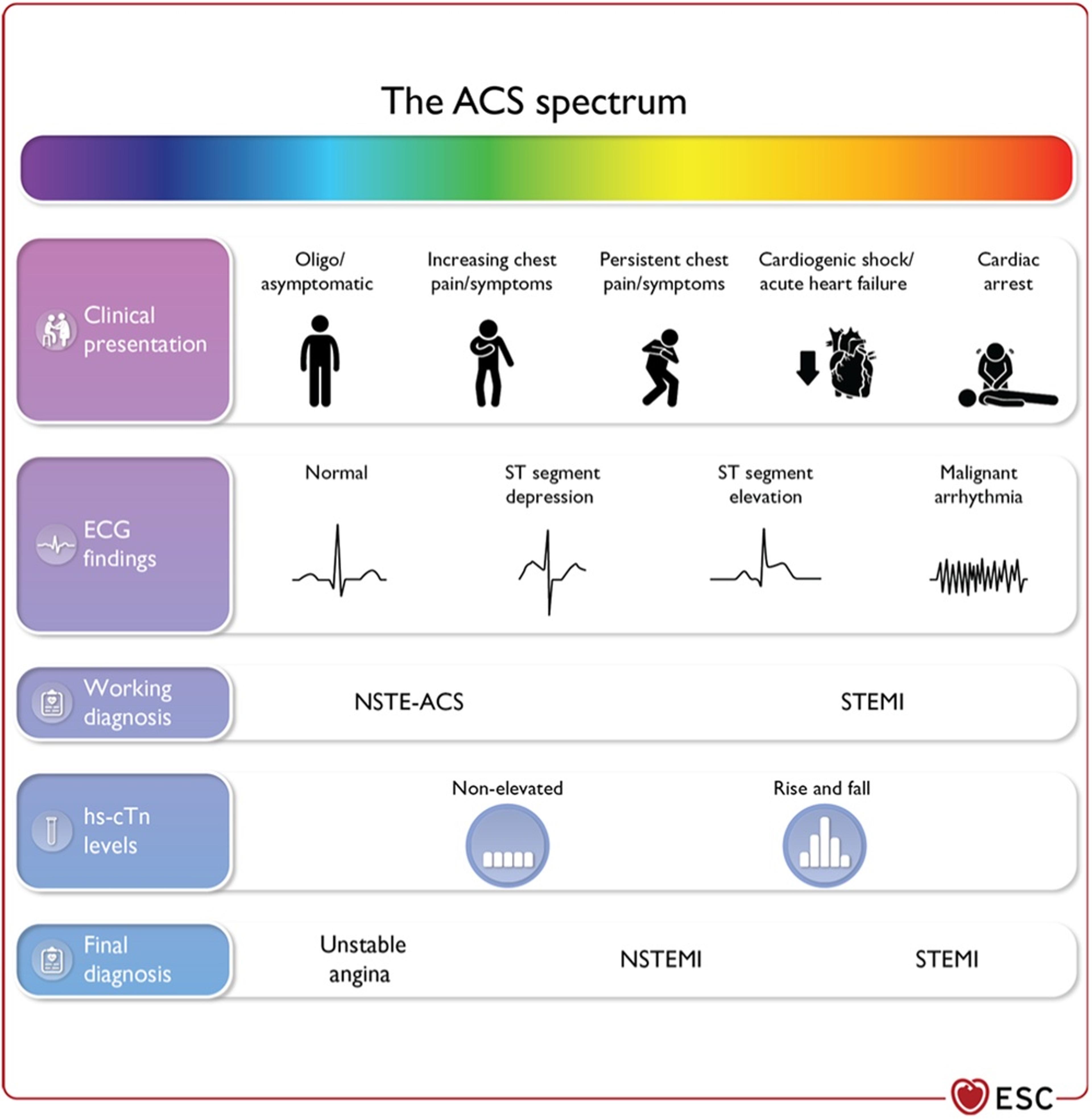 The spectrum of clinical presentations, electrocardiographic findings, and high‐sensitivity cardiac troponin levels in patients with acute coronary syndrome.