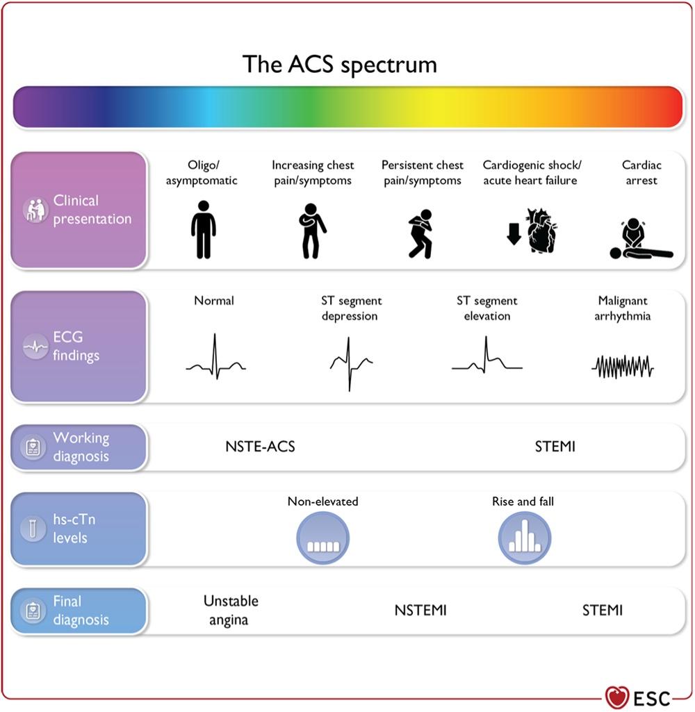 The spectrum of clinical presentations, electrocardiographic findings, and high‐sensitivity cardiac troponin levels in patients with acute coronary syndrome.