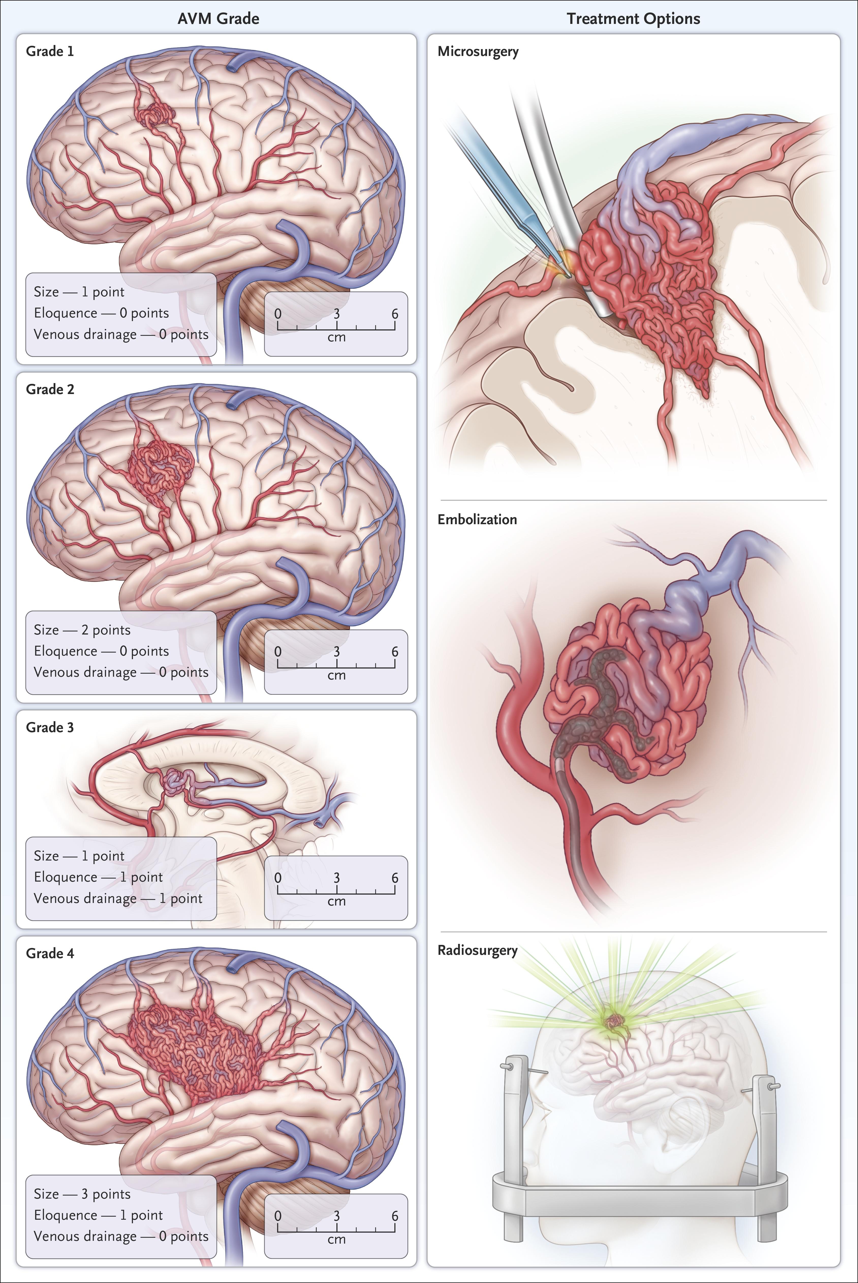 Examples of Spetzler–Martin Grades 1 through 4 Arteriovenous Malformations (AVMs) and Treatment Options.