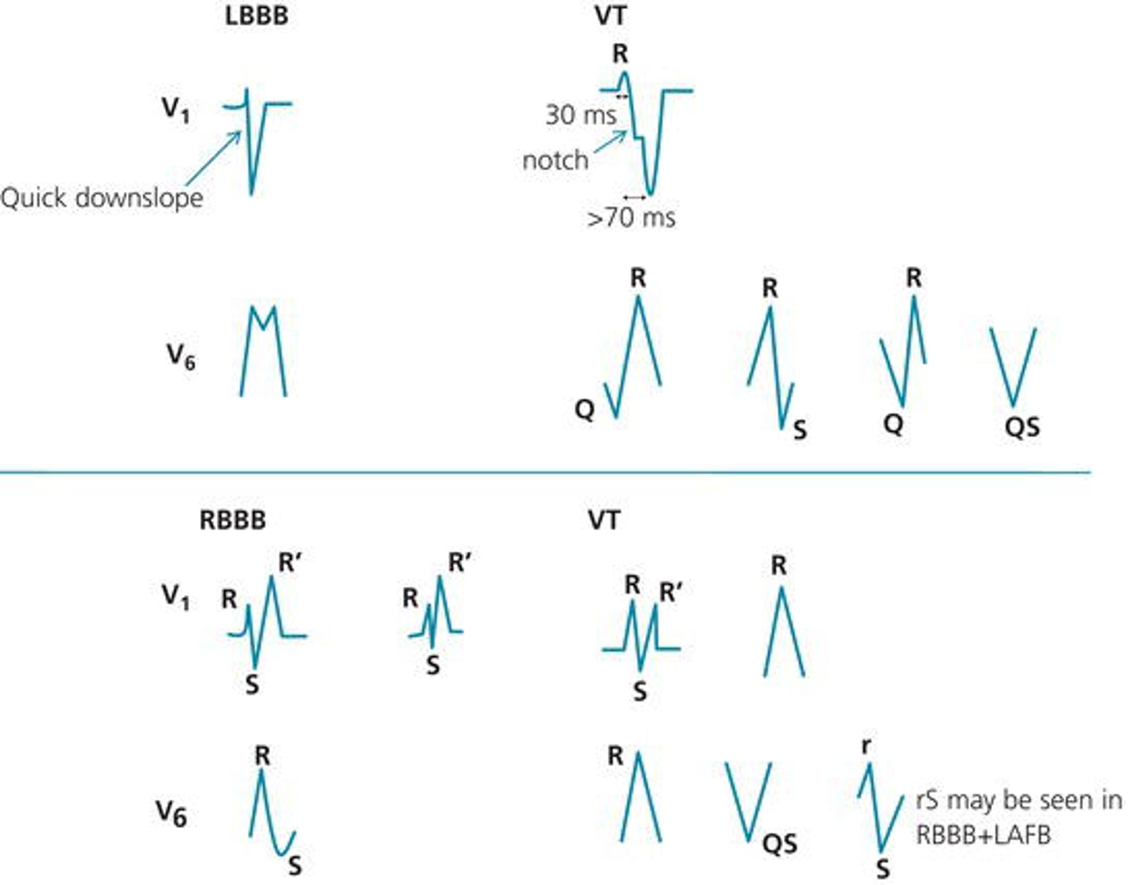 Figure 7. Differences in morphology between SVT with aberrancy and VT. SVT with aberrancy has a typical LBBB or RBBB morphology. Conversely, VT is suggested by: - LBBB with a wide initial R wave >30 ms, R‐to‐nadir of S >70 ms, or notched S descent in V 1 ; or Q wave in V 6 .
- RBBB with a wide R pattern in V 1 instead of RSR', R >R’ in V 1 , or monophasic R or QS in V 6 . RBBB with a left axis or with a rS pattern in V 6 does not necessarily imply VT (could be RBBB + LAFB). While rS pattern in V 6 is not typical of LBBB or RBBB, it may be seen with atypical LBBB (enlarged LV) or RBBB + LAFB. Deep Q in V 6 (QS or Qr) implies VT. Left QRS axis may be seen with LBBB or RBBB + LAFB. Right QRS axis, on the other hand, is not typically seen with either LBBB or RBBB and usually implies VT.