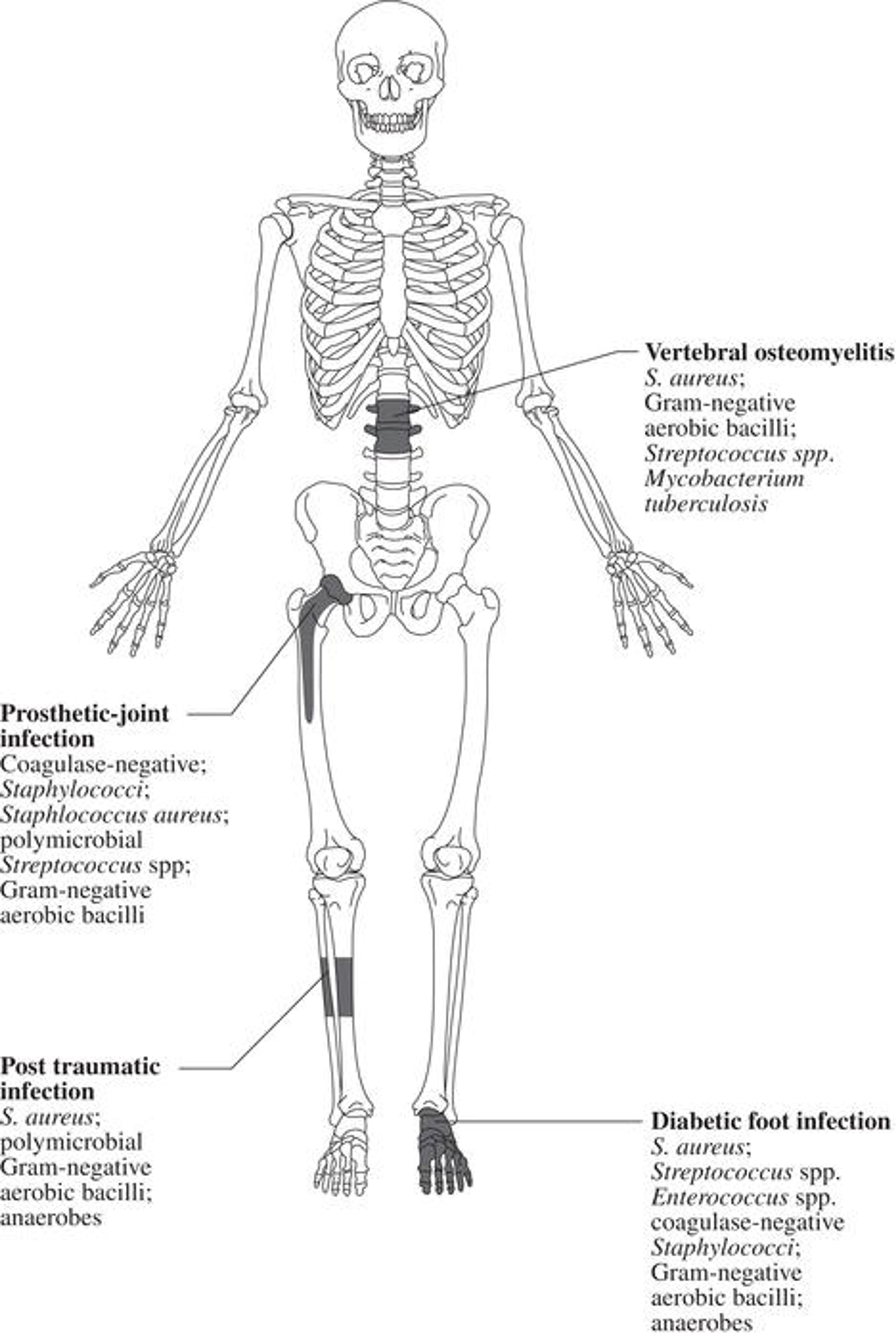 The microbiology of osteomyelitis. The microorganisms of osteomyelitis in order of prevalence from high to low by site of infection. (Reproduced from /With permission of Elsevier.)