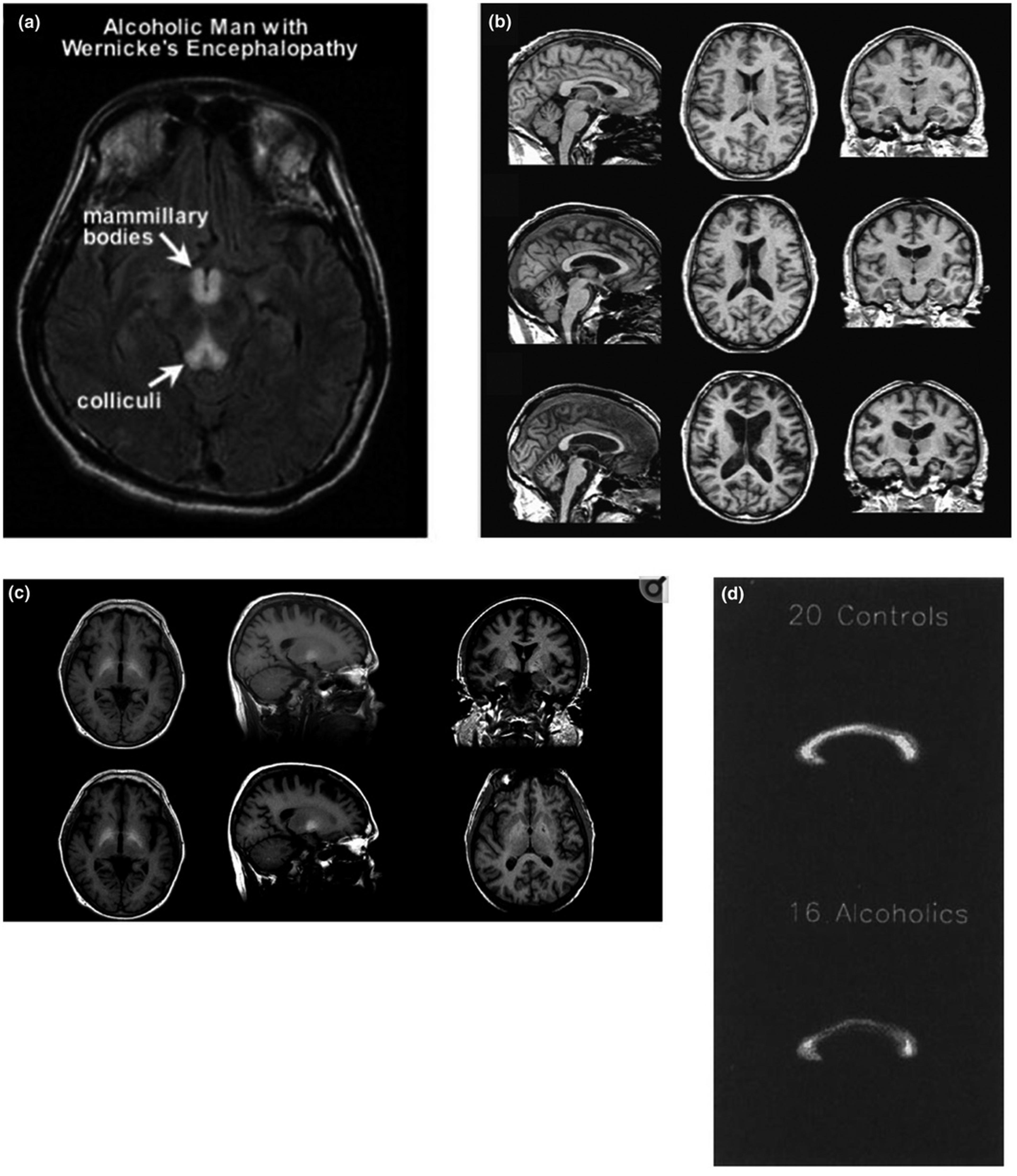 (a) Brain image of an alcoholic man with Wernicke’s encephalopathy showing hypertensities in mammilary bodies and colliculi (reprint with permission from (Sullivan & Zahr, 2008 )).