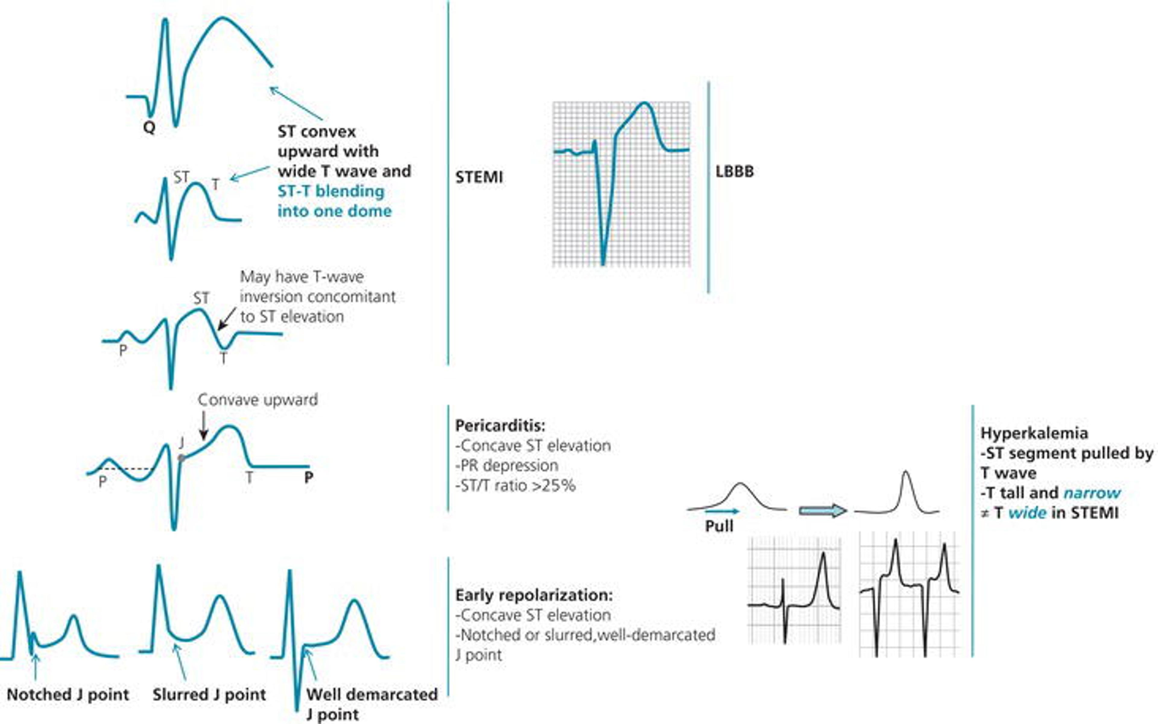 Various patterns of ST‐segment elevation. Reproduced with permission of the Cleveland Clinic Foundation from Hanna and Glancy (2011).