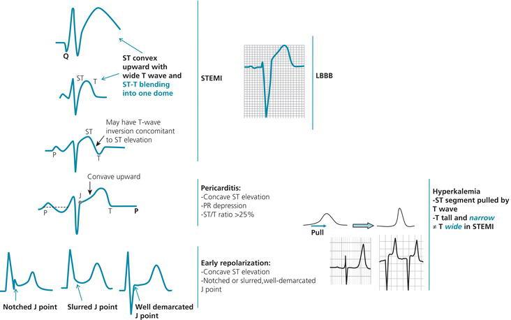 Various patterns of ST‐segment elevation. Reproduced with permission of the Cleveland Clinic Foundation from Hanna and Glancy (2011).